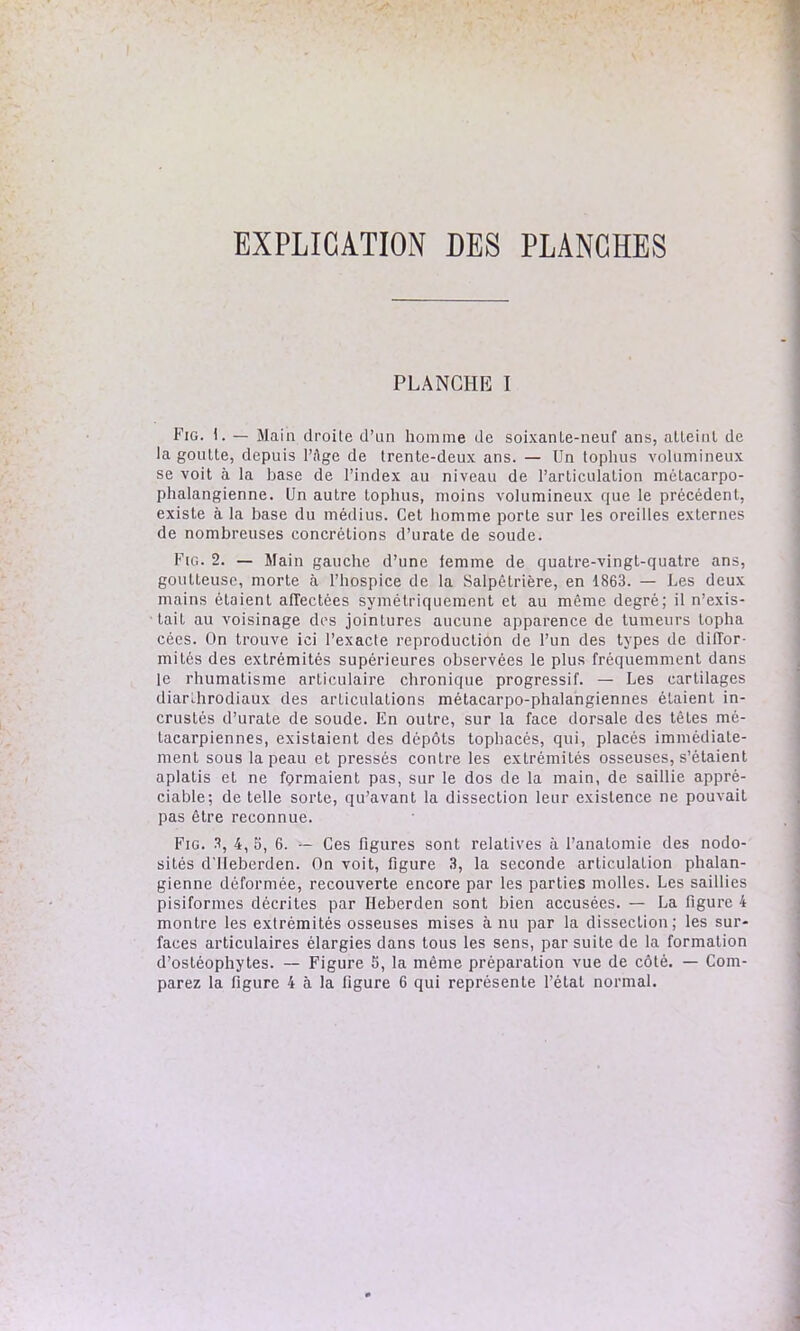 EXPLICATION DES PLANCHES PLANCHE I Fig. I. — Main droile d’un homme de soixante-neuf ans, atleinl de la goutte, depuis l’Age de trente-deux ans. — Un toplius volumineux se voit à la hase de l’index au niveau de l’articulation métacarpo- phalangienne. Un autre tophus, moins volumineux que le précédent, existe à la base du médius. Cet homme porte sur les oreilles externes de nombreuses concrétions d’urate de soude. Fig. 2. — Main gauche d’une femme de quatre-vingt-quatre ans, goutteuse, morte à l’hospice de la Salpêtrière, en 1863. — Les deux mains étaient affectées symétriquement et au même degré; il n’exis- tait au voisinage des jointures aucune apparence de tumeurs lopha cées. On trouve ici l’exacte reproduction de l’un des types de diffor- mités des extrémités supérieures observées le plus fréquemment dans le rhumatisme articulaire chronique progressif. — Les cartilages diarlhrodiaux des articulations métacarpo-phalangiennes étaient in- crustés d’urate de soude. En outre, sur la face dorsale des têtes mé- tacarpiennes, existaient des dépôts tophacés, qui, placés immédiate- ment sous la peau et pressés contre les extrémités osseuses, s’étaient aplatis et ne formaient pas, sur le dos de la main, de saillie appré- ciable; de telle sorte, qu’avant la dissection leur existence ne pouvait pas être reconnue. Fig. 3, 4, S, 6. — Ces figures sont relatives à l’anatomie des nodo- sités d'IIeberden. On voit, figure 3, la seconde articulation phalan- gienne déformée, recouverte encore par les parties molles. Les saillies pisiformes décrites par Heberden sont bien accusées. — La figure 4 montre les extrémités osseuses mises à nu par la dissection; les sur- faces articulaires élargies dans tous les sens, par suite de la formation d’osléophytes. — Figure 5, la même préparation vue de côté. — Com-