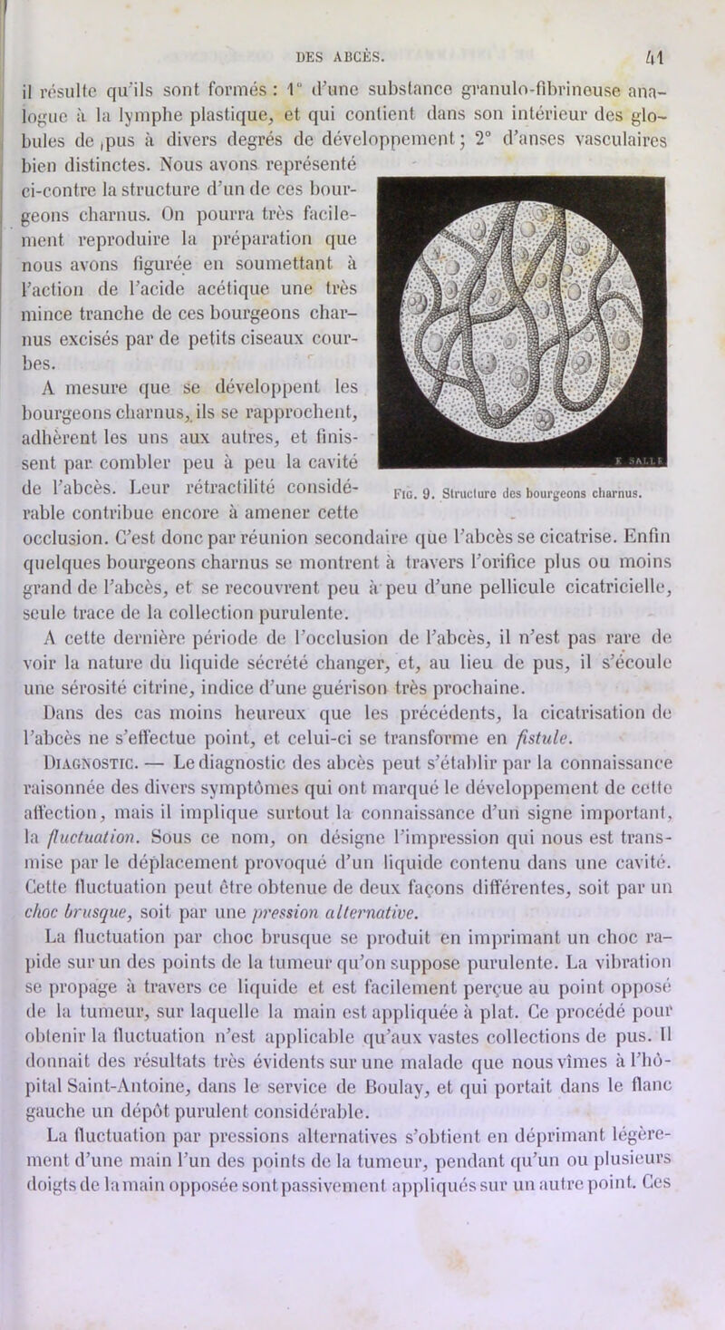 il résulte qu'ils sont formés: 1 d'une substance granulo-fdn’ineuse ana- logue à la lymphe plastique, et qui contient dans son intérieur des glo- ( bules de ,pus à divers degrés de développement j 2 d’anses vasculaires bien distinctes. Nous avons représenté ci-contre la structure d’un de ces bour- geons charnus. On pourra très facile- ment reproduire la préparation que nous avons figurée en soumettant à l'action de l’acide acétique une très mince tranche de ces bourgeons char- nus excisés par de petits ciseaux cour- bes. A mesure que se développent les bourgeons charnus,, ils se rapprochent, adhèrent les uns aux autres, et tinis- sent par. combler peu à peu la cavité de 1 abcès, bcui létiactilité considé- structure des bourgeons charnus, rable contribue encore à amener cette occlusion. C'est donc par réunion secondaire que l'abcès se cicatrise. Enfin quelques bourgeons charnus se montrent à travers l'orifice plus ou moins grand de l'abcès, et se recouvrent peu à peu d'une pellicule cicatricielle, seule trace de la collection purulente. A cette dernière période de l’occlusion de l'abcès, il n’est pas rare de voir la nature du liquide sécrété changer, et, au lieu de pus, il s’écoule une sérosité citrine, indice d'une guérison très prochaine. Dans des cas moins heureux que les précédents, la cicatrisation de l'abcès ne s'effectue point, et celui-ci se transforme en fistule. Diagnostic. — Le diagnostic des abcès peut s’établir par la connaissance raisonnée des divers symptômes qui ont marqué le développement de cette ali'ection, mais il implique surtout la connaissance d’un signe important, la fluctuation. Sous ce nom, on désigne l’impression qui nous est trans- mise par le déplacement provoqué d'un liquide contenu dans une cavité. Cette fluctuation peut être obtenue de deux façons différentes, soit par un choc brusque, soit par une pression alternative. La fluctuation par choc bnisque se produit en imprimant un choc ra- pide sur un des points de la fumeur qu'on suppose purulente. La vibration se propage à travers ce liquide et est facilement perçue au point opposé de la tumeur, sur laquelle la main est appliquée à plat. Ce procédé pour obtenir la tluctuation n’est applicable qu’aux vastes collections de pus. Il donnait des résultats très évidents sur une malade que nous vîmes à l'iiù- pital Saint-Antoine, dans le service de Boulay, et qui portait dans le flanc gauche un dépôt purulent considérable. La fluctuation par pressions alternatives s’obtient en déprimant légère- ment d’une main l'un des points de la tumeur, pendant qu’un ou plusieurs doigts de la main opposée sont passivement ajipliquéssur un autre point. Ces