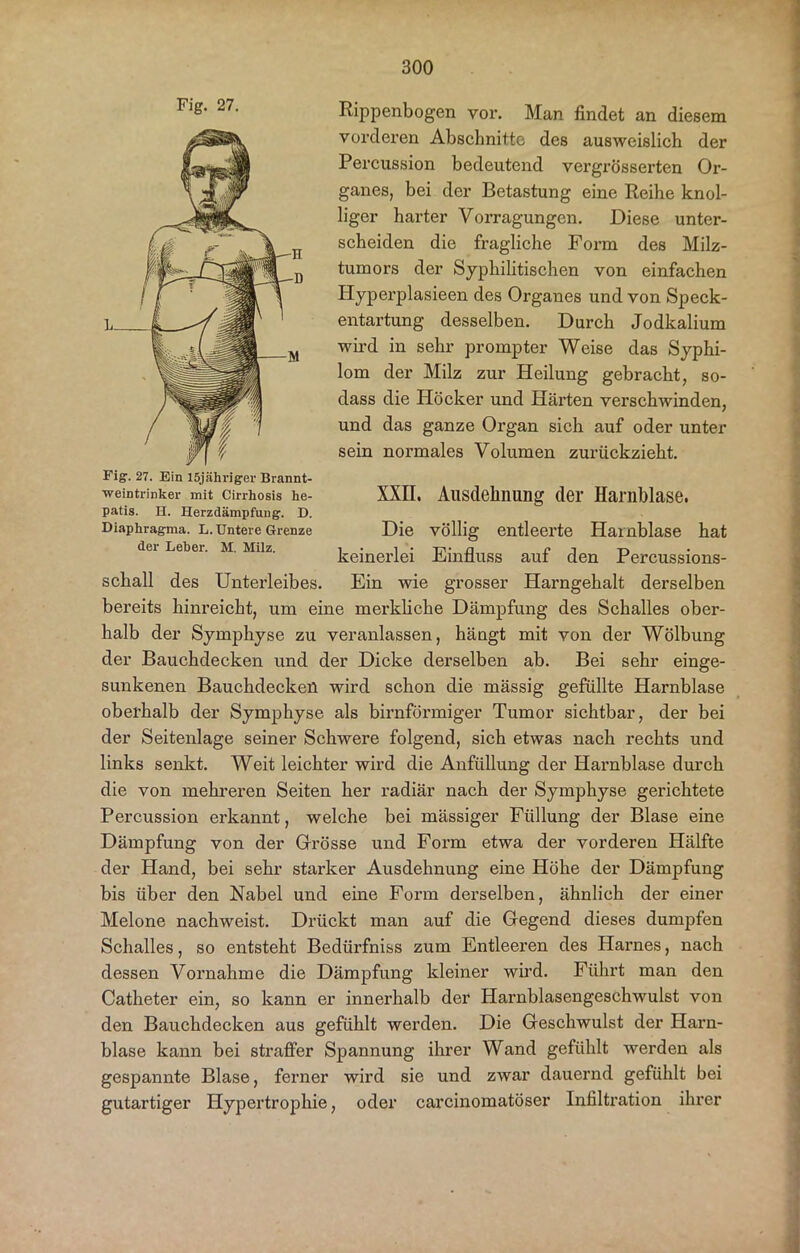 Rippenbogen vor. Man findet an diesem vorderen Abschnitte des ausweislich der Percussion bedeutend vergrösserten Or- ganes, bei der Betastung eine Reihe knol- liger harter Vorragungen. Diese unter- scheiden die fragliche Form des Milz- tumors der Syphilitischen von einfachen Hyperplasieen des Organes und von Speck- entartung desselben. Durch Jodkalium wird in sehr prompter Weise das Syphi- lom der Milz zur Heilung gebracht, so- dass die Höcker und Härten verschwinden, und das ganze Organ sich auf oder unter sein normales Volumen zurückzieht. Fig. 27. Ein 15jübriger Brannt- weintrinker mit cirrhosis be- XXII. Ausdehnung der Harnblase. patis. H. Herzdämpfung. D. Diaphragma, l. Untere Grenze Die völlig entleerte Harnblase hat der Leber. M. Milz. i i • ta* u r j t> keinerlei Üdnnuss aut den rercussions- schall des Unterleibes. Ein wie grosser Harngehalt derselben bereits hinreicht, um eine merkliche Dämpfung des Schalles ober- halb der Symphyse zu veranlassen, hängt mit von der Wölbung der Bauchdecken und der Dicke derselben ab. Bei sehr einge- sunkenen Bauchdecken wird schon die mässig gefüllte Harnblase oberhalb der Symphyse als bimförmiger Tumor sichtbar, der bei der Seitenlage seiner Schwere folgend, sich etwas nach rechts und links senkt. Weit leichter wird die Anfüllung der Harnblase durch die von mehreren Seiten her radiär nach der Symphyse gerichtete Percussion erkannt, welche bei mässiger Füllung der Blase eine Dämpfung von der Grösse und Form etwa der vorderen Hälfte der Hand, bei sehr starker Ausdehnung eine Höhe der Dämpfung bis über den Nabel und eine Form derselben, ähnlich der einer Melone nachweist. Drückt man auf die Gegend dieses dumpfen Schalles, so entsteht Bedürfniss zum Entleeren des Harnes, nach dessen Vornahme die Dämpfung kleiner wird. Führt man den Catheter ein, so kann er innerhalb der Harnblasengeschwulst von den Bauchdecken aus gefühlt werden. Die Geschwulst der Harn- blase kann bei straffer Spannung ihrer Wand gefühlt werden als gespannte Blase, ferner wird sie und zwar dauernd gefühlt bei gutartiger Hypertrophie, oder carcinomatöser Infiltration ihrer