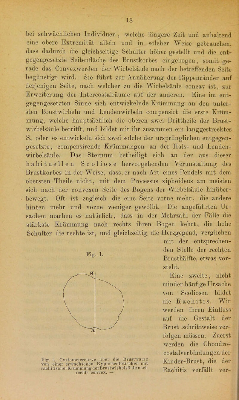 bei scbwäclilichen Indiviclueu , welche längere Zeit und anhaltend eine obere Itxtreniitiit allein und in solcher Weise gebrauchen, dass dadurch die gleichseitige Schulter höher gestellt und die ent- gegengesetzte Seitenfläche des Brustkorbes eingebogen, somit ge- rade das Convexwerden der Wirbelsäule nach der betrefieuden Seite begünstigt Avii-d. Sie führt zur Annäherung der Rippenränder auf derjenigen Seite, nach welcher zu die Wirbelsäule concav ist, zur Erweiterung der Intercostalräume auf der anderen. Eine iin ent- gegengesetzten Sinne sich entwickelnde Krümmung au den unter- sten Brustwirbeln und Lendenwirbeln compensirt die erste Krüm- mung, welche hauptsächlich die oberen zwei Drittheile der Brust- wirbelsäule betrifft, und bildet mit ihr zusammen ein langgestrecktes S, oder es entwickeln sich zwei solche der ursprünglichen entgegen- gesetzte, compensirende Krümmungen au der Hals- und Leuden- wirbelsäule. Das Sternum betheiligt sich an der aus dieser habituellen Scoliose hervorgehenden Verunstaltung des Brustkorbes in der Weise, dass, er nach Art eines Pendels mit dem obersten Theile nicht, mit dem Processus xiphoideus am meisten sich nach der convexen Seite des Bogens der Wirbelsäule hinüber- bewegt. Oft ist zugleich die eine Seite vorne mehr, die andere hinten mehr und vorne weniger gewölbt. Die angeführten Ur- sachen machen es natürlich, dass in der Mehrzahl der Fälle die stärkste Krümmung nach rechts ihren Bogen kehrt, die hohe Schulter die rechte ist, und gleichzeitig die Herzgegend, verglichen mit der entsprechen- den Stelle der rechten Brusthälfte, etwas vor- steht. Eine zweite, nicht minder häufige Ursache von Scoliosen bildet die Rachitis. Wir werden ihren Einfluss auf die Gestalt der Brust schrittweise ver- folgen müsseu. Zuerst werden die Chondro- costalverbinduugen der Kinder-Brust, die der Rachitis verfUllt ver- Fig. 1. Fiff. 1. Cyrtometeruiirvc über die Brustw.ai-ze von einer erw.aehsenen Kyiilioscolotischen mit riiehiti8clierKrUinuiuny:derUru8l Wirbelsäule nueli reelits eonve.x. —