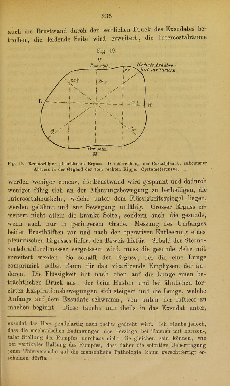 auch die Brustwaud durch den seitlichen Druck des Exsudates be- troffen , die leidende Seite wird erweitert, die Intercostalräuuie Fig. 19. V Fig. 19. Rechtseitiger pleuritiseher Erguss. Durchbrechung der Costalpleura, subcutaner Abscess in der Gegend der 7ten rechten Rippe. Cyrtometercurve. . werden weniger concav, die Brustwand wird gespannt und dadurch weniger fähig sich an der Athmungsbewegung zu betheiligen, die Intercostalmuskeln, welche unter dena Plüssigkeitsspiegel liegen, werden gelähmt und zur Bewegung unfähig. Grosser Erguss er- weitert nicht allein die kranke Seite, sondern auch die gesunde, wenn auch nur in geringerem Grade. Messung des Umfanges beider Brusthälften vor und nach der operativen Entleerung eines pleuritischen Ergusses liefert den Beweis hiefür. Sobald der Sterno- vertebraldurchmesser vergrössert wird, muss die gesunde Seite mit ■ erweitert werden. So schafft der Erguss, der die eine Lunge comprimirt, selbst Raum für das vicariirende Emphysem der an- deren. Die Flüssigkeit übt nach oben auf die Lunge einen be- trächtlichen Druck aus, der beim Husten und bei ähnlichen for- cirten Exspirationsbewegungen sich steigert und die Lunge, welche Anfangs auf,dem Exsudate schwamm, von unten her luftleer zu machen beginnt. Diese taucht nun theils in das Exsudat unter, exsudat das Herz pendelartig nach rechts gedreht wird. Ich glaube jedoch, dass die mechanischen Bedingungen der Herzlage bei Thieren mit horizon-, taler Stellung des Eumpfes durchaus nicht die gleichen sein können, wie bei vertikaler Haltung des Rumpfes, dass daher die sofortige Uebertragung jener Thierversuche auf die menschliche Pathologie kaum gerechtfertigt er- scheinen dürfte.