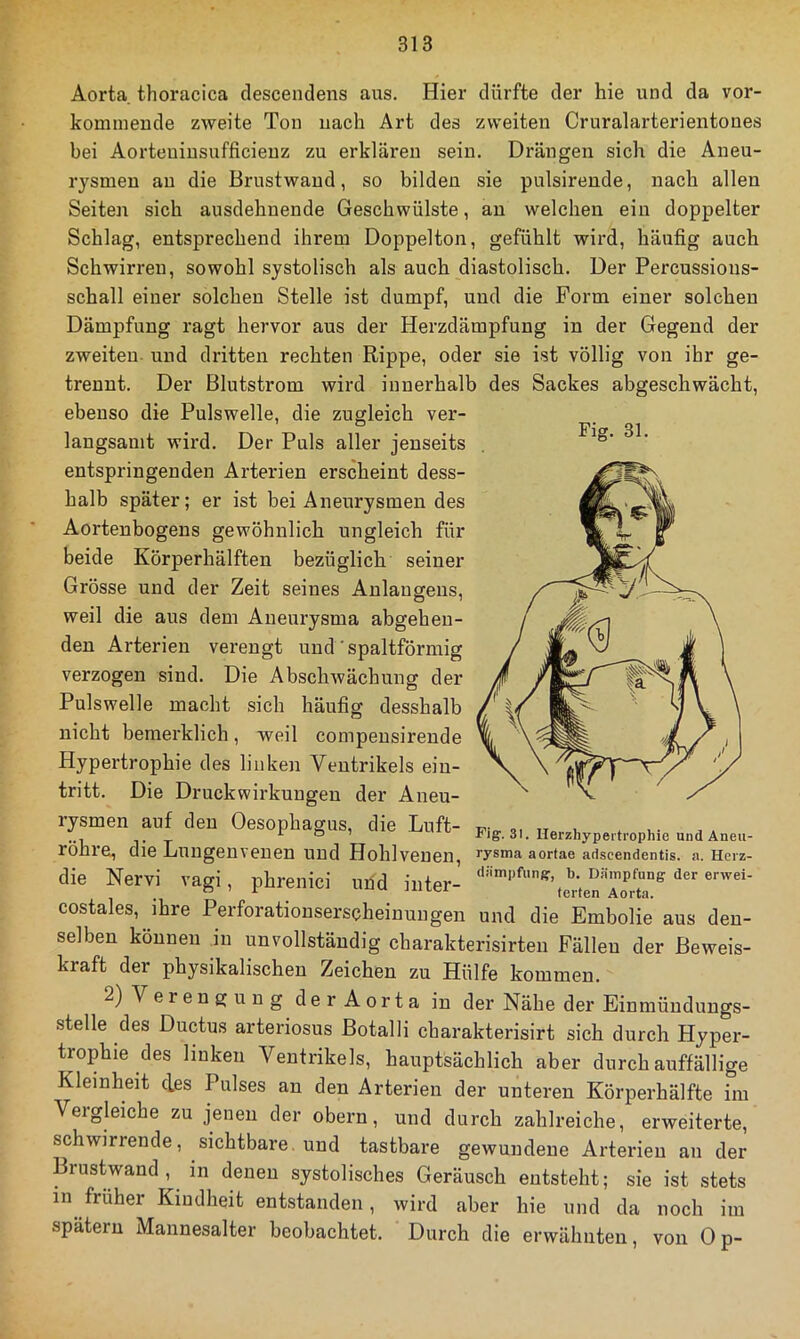 Aorta thoracica descendens aus. Hier dürfte der hie und da vor- kommeude zweite Ton nach Art des zweiten Cruralarterientoues bei Aorteuiusufficieuz zu erklären sein. Drängen sich die Aneu- rysmen au die Brustwaud, so bilden sie pulsirende, nach allen Seiten sich ausdehnende Geschwülste, an welchen ein doppelter Schlag, entsprechend ihrem Doppelton, gefühlt wird, häufig auch Schwirren, sowohl systolisch als auch diastolisch. Der Percussious- schall einer solchen Stelle ist dumpf, und die Form einer solchen Dämpfung ragt hervor aus der Herzdämpfung in der Gegend der zweiten- und dritten rechten Rippe, oder sie ist völlig von ihr ge- trennt. Der Blutstrom wird innerhalb des Sackes abgeschwächt, ebenso die Pulswelle, die zugleich ver- langsamt wird. Der Puls aller jenseits entspringenden Arterien erscheint dess- halb später; er ist bei Aneurysmen des Aortenbogens gewöhnlich ungleich für beide Körperhälften bezüglich seiner Grösse und der Zeit seines Anlaugeus, weil die aus dem Aneurysma abgeheu- den Arterien verengt und ' spaltförmig verzogen sind. Die Abschwächung der Pulswelle macht sich häufig desshalb nicht bemerklich, weil compensirende Hypertrophie des linken Ventrikels ein- tritt. Die Druckwirkungen der Aneu- rysmen auf den Oesophagus, die Luft- i * ,.• r ö 1 Fig. 31. llerzliyperti’ophie und Aneu- rohre, die Lungeuvenen und Hohlvenen, rysma aortae adscendentis. a. Herz- die Nervi vagi, phrenici und inter- costales, ihre Perforationserscheinungen und die Embolie aus den- selben können Ri unvollständig charakterisirten Fällen der Beweis- kraft der physikalischen Zeichen zu Hülfe kommen. 2) V e r e n g u n g d e r A o r t a in der Nähe der Einmündungs- stelle des Ductus arteriosus Botalli charakterisirt sich durch Hyper- trophie des linken Ventrikels, hauptsächlich aber durch auffällige Kleinheit des Pulses an den Arterien der unteren Körperhälfte im Veigleiche zu jenen der obern, und durch zahlreiche, erweiterte, schwirrende, sichtbare, und tastbare gewundene Arterien an der Brustwand , in denen systolisches Geräusch entsteht; sie ist stets in früher Kindheit entstanden, wird aber hie und da noch im spätem Mannesalter beobachtet. Durch die erwähnten, von 0 p-