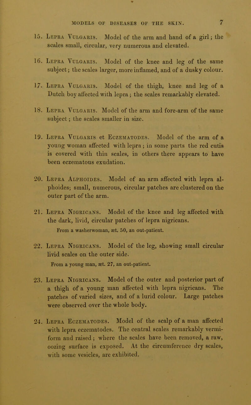 15. Lepra Vulgaris. Model of the arm and band of a girl; the scales small, circular, very numerous and elevated. 1(). Lepra Vulgaris. Model of the knee and leg of the same subject; the scales larger, more inflamed, and of a dusky colour. 17. Lepra Vulgaris. Model of the thigh, knee and leg of a Dutch boy atf'ected with lepra; the scales remarkably elevated. 18. Lepra Vulgaris. Model of the arm and fore-arm of the same subject; the scales smaller in size. 19. Lepra Vulgaris et Eczematodes. Model of the arm of a young woman affected with lepra; in some parts the red cutis is covered with thin scales, in others there appears to have been eczematous exudation. 20. Lepra Alphoides. Model of an arm affected with lepra al- phoides; small, numerous, circular patches are clustered on the outer part of the arm. 21. Lepra Nigricans. Model of the knee and leg affected with the dark, livid, circular patches of lepra nigricans. From a washerwoman, aet. 50, an out-patient. 22. Lepra Nigricans. Model of the leg, showing small circular livid scales on the outer side. From a young man, aet. 27, an out-patient. 23. Lepra Nigricans. Model of the outer and posterior part of a thigh of a young man affected with lepra nigricans. The patches of varied sizes, and of a lurid colour. Large patches were observed over the whole body. 24. Lepra Eczematodes. Model of the scalp of a man affected with lepra eczematodes. The central scales remarkably vermi- form and raised; where the scales have been removed, a raw, oozing surface is exposed. At the circumference dry scales, with some vesicles, arc exhibited.