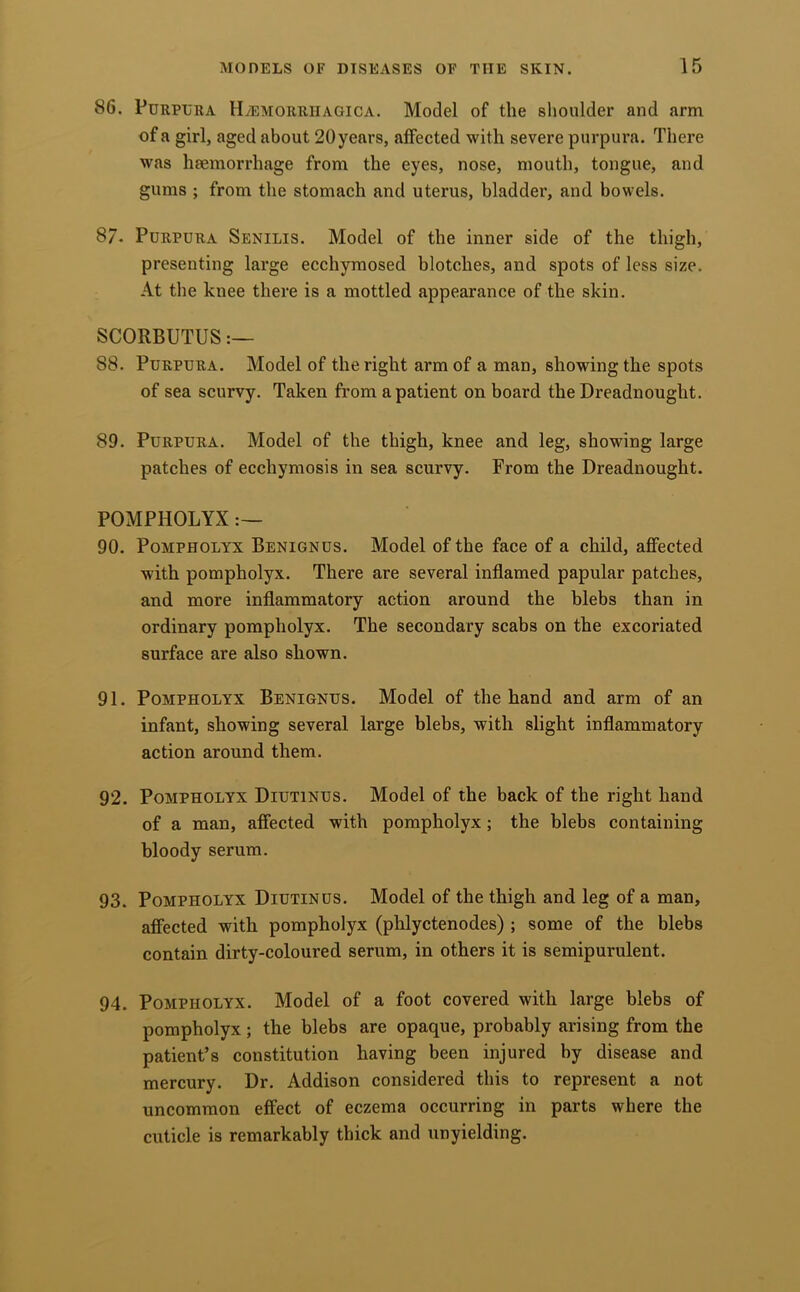86. PuRPL'RA Hvemorriiagica. Model of the shoulder and arm of a girl, aged about 20years, affected with severe purpura. There was haemorrhage from the eyes, nose, mouth, tongue, and gums ; from the stomach and uterus, bladder, and bowels. 87- Purpura Senilis. Model of the inner side of the thigh, presenting large ecchymosed blotches, and spots of less size. At the knee there is a mottled appearance of the skin. SCORBUTUS 88. Purpura. Model of the right arm of a man, showing the spots of sea scurvy. Taken from a patient on board the Dreadnought. 89. Purpura. Model of the thigh, knee and leg, showing large patches of ecchymosis in sea scurvy. From the Dreadnought. POMPHOLYX 90. PoMPHOLYX Benign US. Model of the face of a child, affected with pompholyx. There are several inflamed papular patches, and more inflammatory action around the blebs than in ordinary pompholyx. The secondary scabs on the excoriated surface are also shown. 91. Pompholyx Benignus. Model of the hand and arm of an infant, showing several large blebs, with slight inflammatory action around them. 92. Pompholyx Diutinus. Model of the back of the right hand of a man, affected with pompholyx; the blebs containing bloody serum. 93. Pompholyx Diutinus. Model of the thigh and leg of a man, affected with pompholyx (phlyctenodes) ; some of the blebs contain dirty-coloured serum, in others it is semipurulent. 94. Pompholyx. Model of a foot covered with large blebs of pompholyx; the blebs are opaque, probably arising from the patient’s constitution having been injured by disease and mercury. Dr. Addison considered this to represent a not uncommon effect of eczema occurring in parts where the cuticle is remarkably thick and unyielding.