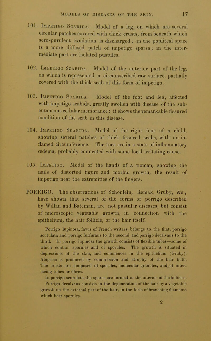101. Impetigo Scabida. Model of a leg, on which are several circular patches covered with thick crusts, from beneath which sero-purulent exudation is discharged ; in the popliteal space is a more diffused patch of impetigo sparsa; in the inter- mediate part are isolated pustules. 102. Impetigo Scabida. Model of the anterior part of the leg, on wliich is represented a circumscribed raw surface, partially covered with the thick scab of this form of impetigo. 103. Impetigo Scabida. Model of the foot and leg, affected with impetigo scabida, greatly swollen with disease of the sub- cutaneous cellular membrance ; it shows the remarkable fissured condition of the scab in this disease. 104. Impetigo Scabida. Model of the right foot of a child, showing several patches of thick fissured scabs, with an in- flamed circumference. The toes are in a state of inflammatory oedema, probably connected with some local irritating cause. 105. Impetigo. Model of the hands of a woman, showing the nails of distorted figure and morbid growth, the result of impetigo near the extremities of the fingers. PORRIGO. The observations of Schonlein, Remak, Gruby, &c., have shown that several of the forms of porrigo described by Willan and Bateman, are not pustular diseases, but consist of microscopic vegetable growth, in connection with the epithelium, the hair follicle, or the hair itself. Porrigo lupinosa, favus of French writers, belongs to the first, porrigo scutulata and porrigo furfurans to tlie second, and porrigo decalvans to the third. In porrigo lupinosa the growth consists of flexible tubes—some of which contain sporules and of sporules. The growth is situated in depressions of the skin, and commences in the epithelium (Gruby). Alopecia is produced by compression and atrophy of the hair bulb. The crusts are composed of sporules, molecular granules, and; of inter- lacing tubes or fibres. In porrigo scutulata the spores are formed in the interior of the follicles. Porrigo decalvans consists in the degeneration of the hair by a vegetable growth on the external part of the hair, in the form of branching filaments which bear sporules. 9