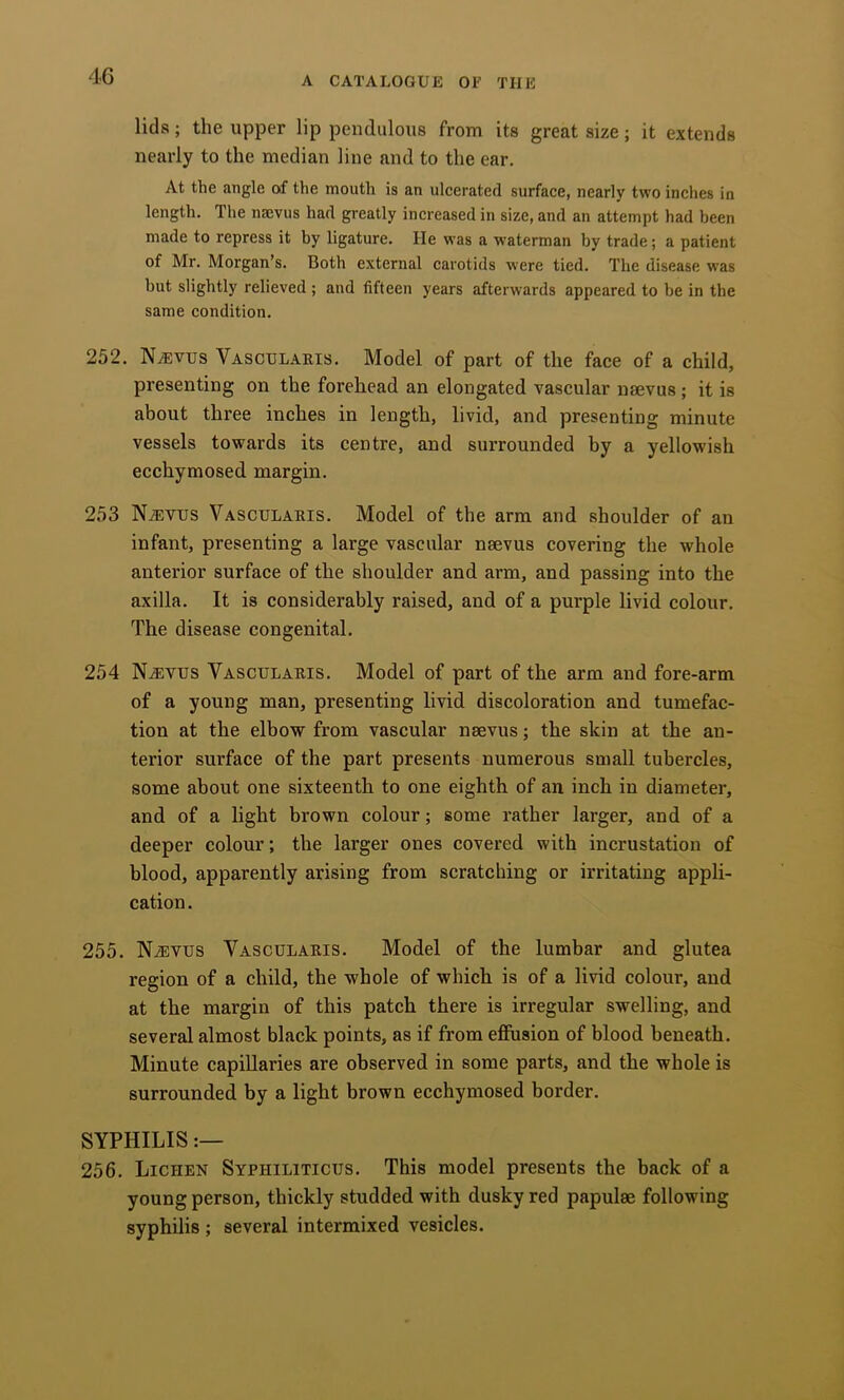lids; the upper lip pendulous from its great size; it extends nearly to the median line and to the ear. At the angle of the mouth is an ulcerated surface, nearly two inches in length. The nasvus had greatly increased in size, and an attempt had been made to repress it by ligature. He was a waterman by trade; a patient of Mr. Morgan’s. Both external carotids w'cre tied. The disease w'as but slightly relieved ; and fifteen years afterwards appeared to be in the same condition. 252. Naivus Vascul.\ris. Model of part of the face of a child, presenting on the forehead an elongated vascular naevus ; it is about three inches in length, livid, and presenting minute vessels towards its centre, and surrounded by a yellowish ecchymosed margin. 253 Naivus Vascularis. Model of the arm and shoulder of an infant, presenting a large vascular naevus covering the whole anterior surface of the shoulder and arm, and passing into the axilla. It is considerably raised, and of a purple livid colour. The disease congenital. 254 Naivus Vascularis. Model of part of the arm and fore-arm of a young man, presenting livid discoloration and tumefac- tion at the elbow from vascular naevus; the skin at the an- terior surface of the part presents numerous small tubercles, some about one sixteenth to one eighth of an inch in diameter, and of a light brown colour; some rather larger, and of a deeper colour; the larger ones covered with incrustation of blood, apparently arising from scratching or irritating appli- cation . 255. Na)vus Vascularis. Model of the lumbar and glutea region of a child, the whole of which is of a livid colour, and at the margin of this patch there is irregular swelling, and several almost black points, as if from effusion of blood beneath. Minute capillaries are observed in some parts, and the whole is surrounded by a light brown ecchymosed border. SYPHILIS 256. Lichen Syphiliticus. This model presents the back of a young person, thickly studded with dusky red papulae following syphilis; several intermixed vesicles.