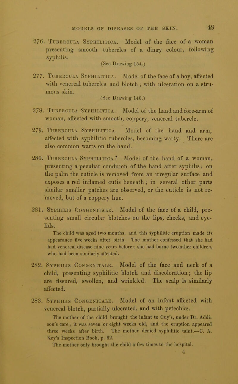 276. Tubehcula Syphilitica. Model of the face of a woman presenting smooth tubercles of a clingy colour, following syphilis. (See Drawing 154.) 277. Tubekcula Syphilitica. Model of the face of a boy, affected with venereal tubercles and blotch ; with ulceration on a stru- mous skin. (See Drawing 140.) 278. Tubekcula Syphilitica. Model of the hand and fore-arm of woman, affected with smooth, coppery, venereal tubercle. 279. Tubekcula Syphilitica. Model of the hand and arm, affected with syphilitic tubercles, becoming warty. There are also common warts on the hand. 280. Tubekcula Syphilitica? Model of the hand of a woman, presenting a peculiar condition of the hand after syphilis; on the palm the cuticle is removed from an irregular surface and exposes a red inflamed cutis beneath; in several other parts similar smaller patches are observed, or the cuticle is not re- moved, but of a coppery hue. 281. Syphilis Congenitale. Model of the face of a child, pre- senting small circular blotches on the lips, cheeks, and eye- lids. The child was aged two months, and this syphilitic eruption made its appearance five weeks after birth. The mother confessed that she had had venereal disease nine years before; she had borne two other children, who had been similarly affected. 282. Syphilis Congenitale. Model of the face and neck of a child, presenting syphilitic blotch and discoloration; the lip are fissured, swollen, and wrinkled. The scalp is similarly affected. 283. Syphilis Congenitale. Model of an infant affected with venereal blotch, partially ulcerated, and with petechiae. The mother of the child brought the infant to Guy’s, under Dr. Addi- son’s care; it was seven or eight weeks old, and the eruption appeared three weeks after birth. The mother denied syphilitic taint.—C. A. Ivey’s Inspection Book, p. 62. The mother only brought the child a few times to the hospital. -I