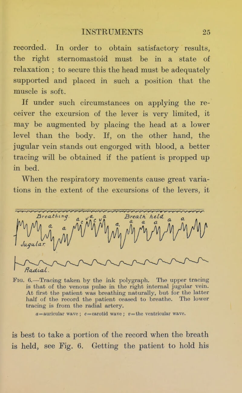 recorded. In order to obtain satisfactory results, the right sternomastoid must be in a state of relaxation ; to secure this the head must be adequatel}^ supported and placed in such a position that the muscle is soft. If under such circumstances on applying the re- ceiver the excursion of the lever is very limited, it may be augmented by placing the head at a lower level than the body. If, on the other hand, the jugular vein stands out engorged with blood, a better tracing will be obtained if the patient is propped up in bed. When the respiratory movements cause great varia- tions in the extent of the excursions of the levers, it Fig. 6.—Tracing taken by the ink polygraph. The upper tracing is that of the venous pulse in the right internal jugular vein. At first the patient was breathing natiu’ally, but for the latter half of the record the patient ceased to breathe. The lower tracing is from the radial artery. a=auricular wave ; c = carotid wave ; r = the ventricular wave. is best to take a portion of the record when the breath is held, see Eig. 6. Getting the patient to hold his