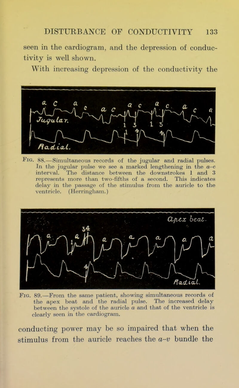 seen in the cardiogram, and the depression of conduc- tivity is well shown. With increasing depression of the conductivity the Fig. 88.—Simultaneous records of the jugular and radial pulses. In the jugular pulse we see a marked lengthening in the a-c interval. The distance between the downstrokes 1 and 3 rejiresents more than two-fifths of a second. This indicates delay in the passage of the stimulus from the auricle to the ventricle. (Herringham.) Fig. 89.—From the same patient, showing simultaneous records of the apex beat and the radial pulse. The increased delay between the systole of the auricle a and that of the ventricle is clearly seen in the cardiogram. conducting power may be so impaired that when the stimulus from the auricle reaches the a-v bundle the