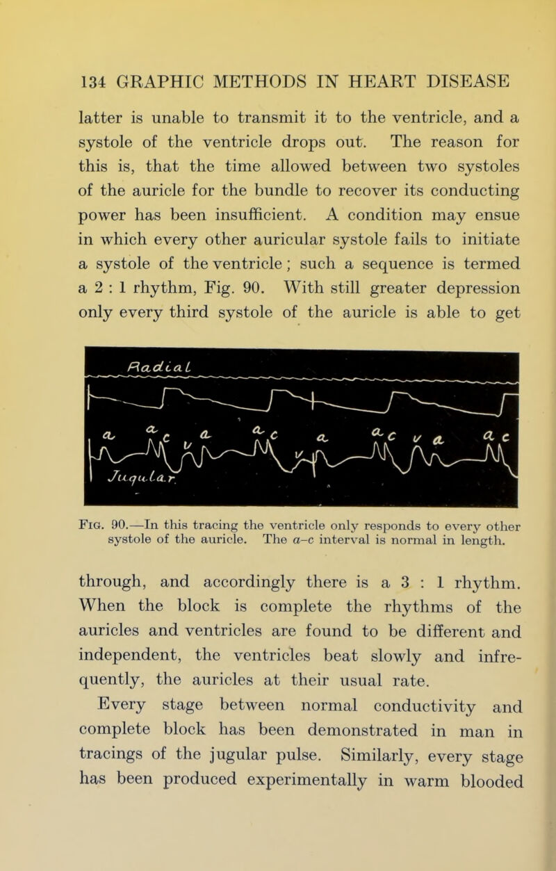 latter is unable to transmit it to the ventricle, and a systole of the ventricle drops out. The reason for this is, that the time allowed between two systoles of the auricle for the bundle to recover its conducting power has been insufficient. A condition may ensue in which every other auricular systole fails to initiate a systole of the ventricle; such a sequence is termed a 2 ; 1 rhythm. Fig. 90. With still greater depression only every third systole of the auricle is able to get Fig. 90.—In this tracing the ventricle only responds to every other systole of the auricle. The a-c interval is normal in length. through, and accordingly there is a 3 ; 1 rhythm. When the block is complete the rhythms of the auricles and ventricles are found to be different and independent, the ventricles beat slowly and infre- quently, the auricles at their usual rate. Every stage between normal conductivity and complete block has been demonstrated in man in tracings of the jugular pulse. Similarly, every stage has been produced experimentally in warm blooded