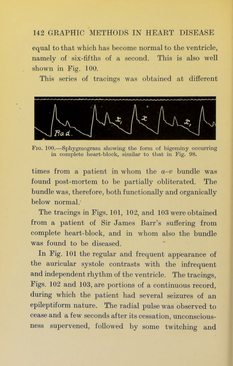 equal to that which has become normal to the ventricle, namely of six-fifths of a second. This is also well shown in Fig. 100. This series of tracings was obtained at different Fig. 100.—Sphygmogram showing the form of bigeminy occurring in complete heart-block, similar to that in Fig. 98. times from a patient in whom the a-v bundle was found post-mortem to be partially obliterated. The bundle was, therefore, both functionally and organically below normal.' The tracings in Figs. 101, 102, and 103 were obtained from a patient of Sir James Barr’s suffering from complete heart-block, and in whom also the bundle was found to be diseased. In Fig. 101 the regular and frequent appearance of the auricular systole contrasts with the infrequent and independent rhythm of the ventricle. The tracings. Figs. 102 and 103, are portions of a continuous record, during which the patient had several seizures of an epileptiform nature. The radial pulse was observed to cease and a few seconds after its cessation, unconscious- ness supervened, followed by some twitching and