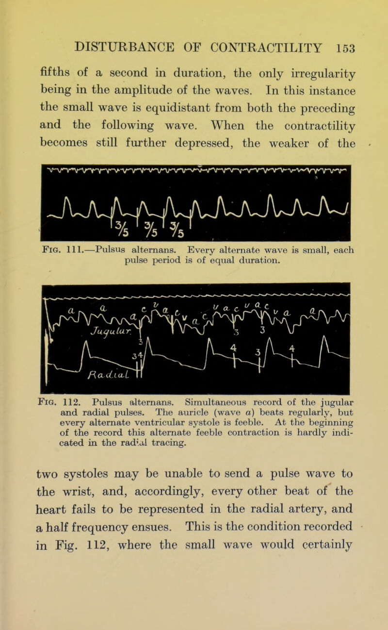 fifths of a second in duration, the only irregularity being in the amplitude of the waves. In this instance the small wave is equidistant from both the preceding and the following wave. When the contractility becomes still further depressed, the weaker of the Fig. 111.—Pulsus altemans. Every alternate wave is small, each pulse period is of equal duration. Fig. 112. Pulsus altemans. Simultaneous record of the jugular and radial pulses. The auricle (wave a) beats regularly, but every alternate ventricular systole is feeble. At the beginning of the record this alternate feeble contraction is hardly indi- cated in the radial tracing. two systoles may be unable to send a pulse wave to the wrist, and, accordingly, every other beat of the heart fails to be represented in the radial artery, and a half frequency ensues. This is the condition recorded in Fig. 112, where the small wave would certainly