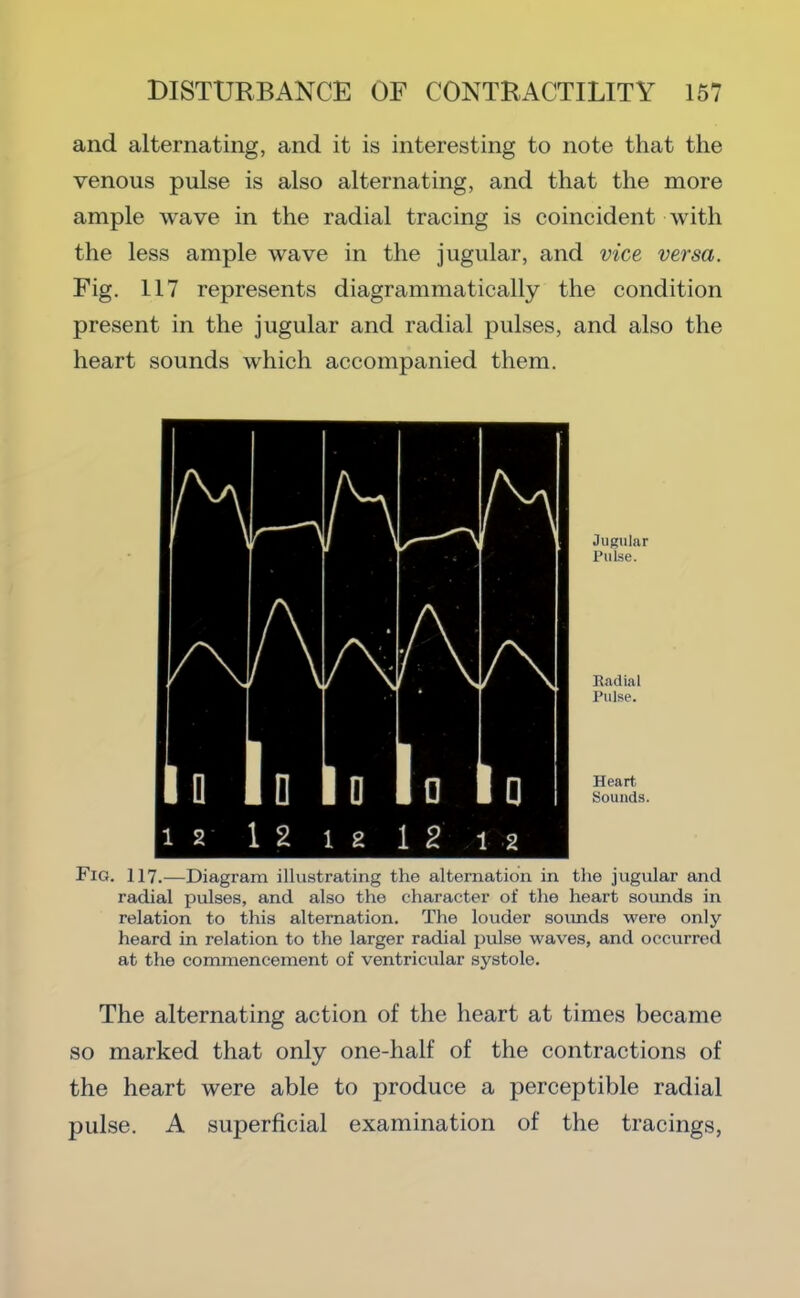 and alternating, and it is interesting to note that the venous pulse is also alternating, and that the more ample wave in the radial tracing is coincident with the less ample wave in the jugular, and vice versa. Fig. 117 represents diagrammatically the condition present in the jugular and radial pulses, and also the heart sounds which accompanied them. Jugular Pulse. Radial Pulse. Heart Sounds. Fig. 117.—Diagram illustrating the alternation in the jugular and radial pulses, and also the character of the heart soimds in relation to this alternation. The louder sounds were only- heard in relation to the larger radial pulse waves, and occurred at the commencement of ventricular systole. The alternating action of the heart at times became so marked that only one-half of the contractions of the heart were able to produce a perceptible radial pulse. A superficial examination of the tracings,