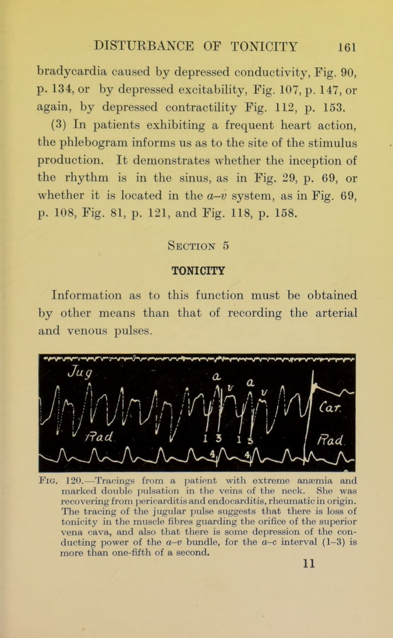 bradycardia caused by depressed conductivity, Fig. 90, p. 134, or by depressed excitability, Fig. 107, p. 147, or again, by depressed contractility Fig. 112, p. 153. (3) In patients exhibiting a frequent heart action, the phlebogram informs us as to the site of the stimulus production. It demonstrates whether the inception of the rhythm is in the sinus, as in Fig. 29, p. 69, or whether it is located in the a-v system, as in Fig. 69, p. 108, Fig. 81, p. 121, and Fig. 118, p. 158. Section 5 TONICITY Information as to this function must be obtained by other means than that of recording the arterial and venous pulses. Fig. 120.—Tracings from a iiatient with extreme aiucmia and marked double pulsation in the veins of the neck. She was recovering from ])ericarditis and endocarditis, rheumatic in origin. The tracing of the jugular pulse suggests that there is loss of tonicity in the muscle fibres guarding the orifice of the superior vena cava, and also that there is some dejiression of the con- ducting power of the a-v bundle, for the a-c interval (1-3) is more than one-fifth of a second. 11