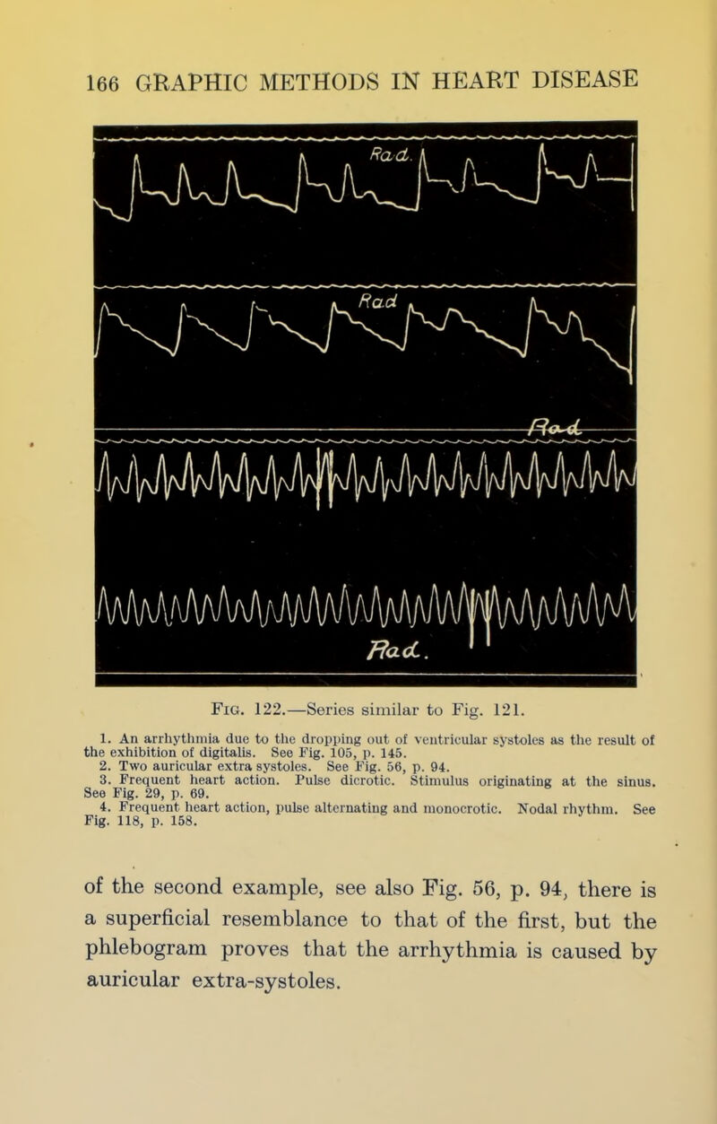 Fig. 122.—Series similar to Fig. 121. 1. An arrhythmia due to the dropping out of ventricular systoles as the result of the exhibition of digitalis. See Fig. 105, p. 145. 2. Two auricular extra systoles. See Fig. 56, p. 94. 3. Frequent heart action. Pulse dicrotic. Stimulus originating at the sinus. See Fig. 29, p. 69. 4. Frequent heart action, pulse alternating and monocrotic. Nodal rhythm. See Fig. 118, p. 158. of the second example, see also Fig. 56, p. 94, there is a superficial resemblance to that of the first, but the phlebogram proves that the arrhythmia is caused by auricular extra-systoles.