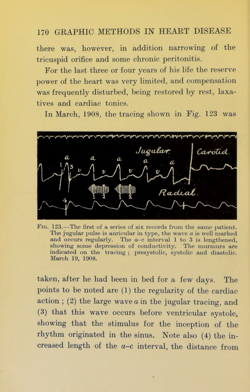 there was, however, in addition narrowing of the tricuspid orifice and some chronic peritonitis. For the last three or four years of his life the reserve power of the heart was very limited, and compensation was frequently disturbed, being restored by rest, laxa- tives and cardiac tonics. In March, 1908, the tracing shown in Fig. 123 was Fig. 123.—The first of a series of six records from the same patient. The jugular pulse is auricular in type, the wave a is well marked and occurs regularly. The a-c interval 1 to 3 is lengthened, showing some depression of conductivity. The murmurs are indicated on the tracing ; presystolic, systolic and diastolic. March 19, 1908. taken, after he had been in bed for a few days. The points to be noted are (1) the regularity of the cardiac action ; (2) the large wave a in the jugular tracing, and (3) that this wave occurs before ventricular systole, showing that the stimulus for the inception of the rhythm originated in the sinus. Note also (4) the in- creased length of the a-c interval, the distance from