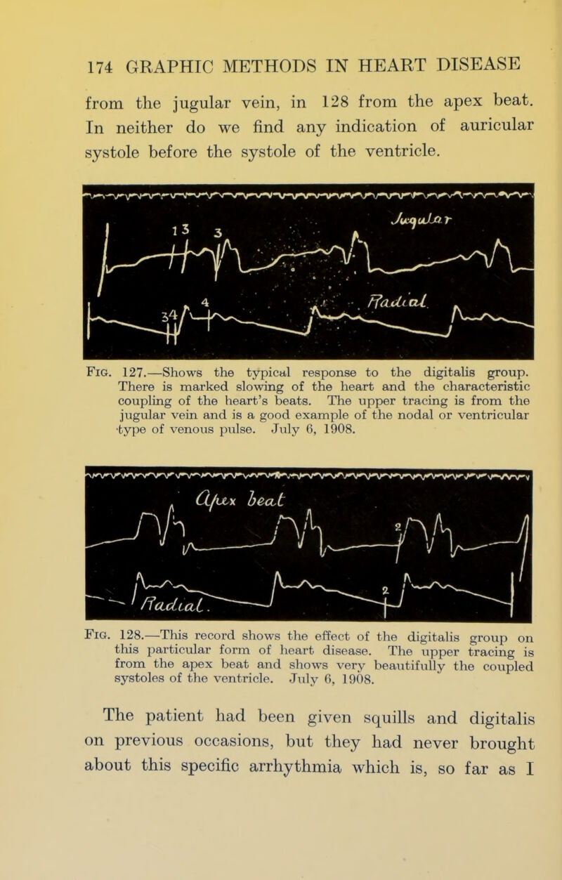 from the jugular vein, in 128 from the apex beat. In neither do we find any indication of auricular systole before the systole of the ventricle. Fig. 127.—Shows the typical response to the digitalis group. There is marked slowing of the heart and the characteristic coupling of the heart’s beats. Tlie upper tracing is from the jugular vein and is a good example of the nodal or ventricular •type of venous pulse. July 6, 1908. Fig. 128.—This record shows the effect of the digitalis group on this particular form of heart disease. The upper tracing is from the apex beat and shows very beautifully the coupled systoles of the ventricle. July 0, 1908. The patient had been given squills and digitalis on previous occasions, but they had never brought about this specific arrhythmia which is, so far as I