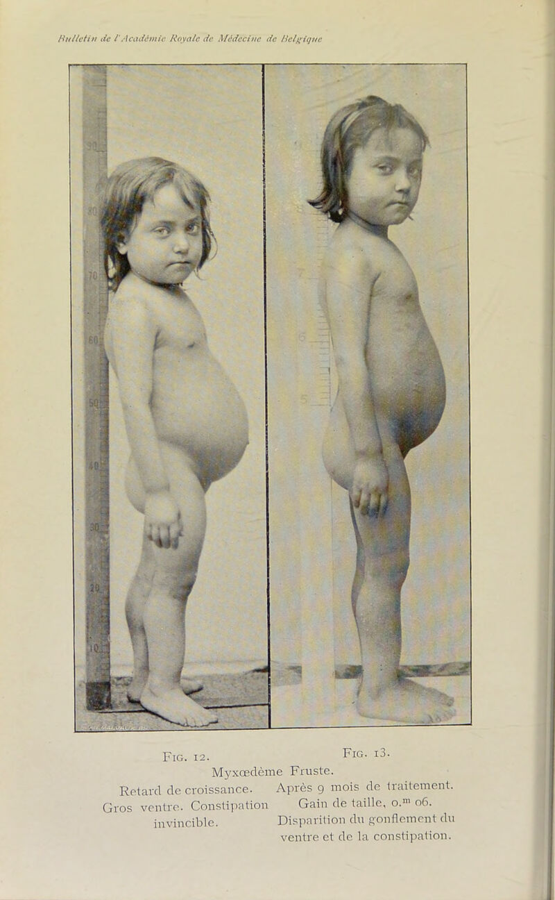 Fig. 12. Fig- Myxœdème Fruste. Retard de croissance. Après 9 mois de traitement. Gros ventre. Constipation Gain de taille, o.m 06. invincible. Disparition du gonflement du ventre et de la constipation.