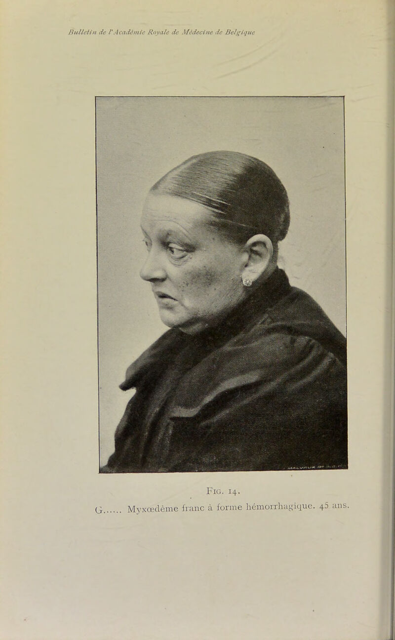 Fig. 14. Myxœdème franc à forme hémorrhagique. 45 ans.