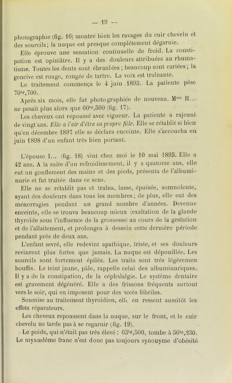 - 19 — photographie (fig. 16) montre bien les ravages du cuir chevelu et des sourcils; la nuque est presque complètement dégarnie. Elle éprouve une sensation continuelle de froid. La consti- pation est opiniâtre. Il y a des douleurs attribuées au rhuma- tisme. Toutes les dents sont ébranlées ; beaucoup sont cariées; la gencive est rouge, rongée de tartre. La voix est traînante. Le traitement commença le 4 juin 1896. La patiente pèse 70ke,700. Après six mois, elle fut photographiée de nouveau. Mme H... ne pesait plus alors que 60k»,500 (fig. 17). Les cheveux ont repoussé avec vigueur. La patiente a rajeuni de vingt ans. Elle a l’air d’être sa propre fille. Elle se rétablit si bien qu’en décembre 1897 elle se déclara enceinte. Elle s accoucha en juin 1898 d’un enfant très bien portant. L’épouse I... (fig. 18) vint chez moi le 10 mai 1895. Elle a 42 ans. A la suite d’un refroidissement, il y a quatorze ans, elle eut un gonflement des mains et des pieds, présenta de 1 albumi- nurie et fut traitée dans ce sens. Elle ne se rétablit pas et traîna, lasse, épuisée, somnolente, ayant des douleurs dans tous les membres; de plus, elle eut des ménorragies pendant un grand nombre d’années. Devenue enceinte, elle se trouva beaucoup mieux (exaltation de la glande thyroïde sous l’intluence de la grossesse) au cours de la gestation et de l’allaitement, et prolongea à dessein cette dernière période pendant près de deux ans. L’enfant sevré, elle redevint apathique, triste, et ses douleurs revinrent plus fortes que jamais. La nuque est dépouillée. Les sourcils sont fortement épilés. Les traits sont très légèremen bouffis. Le teint jaune, pâle, rappelle celui des albuminuriques. II y a de la constipation, de la céphalalgie. Le système dentaire est gravement dégénéré. Elle a des frissons fréquents surtout vers le soir, qui en imposent pour des accès fébriles. Soumise au traitement thyroïdien, elL en ressent aussitôt les effets réparateurs. Les cheveux repoussent dans la nuque, sur le front, et le cuir chevelu ne tarde pas à se regarnir (fig. 19). Le poids, qui n’était pas très élevé : 63ke,500, tombe à 56ke,230. Le myxœdème franc n’est donc pas toujours synonyme d’obésité