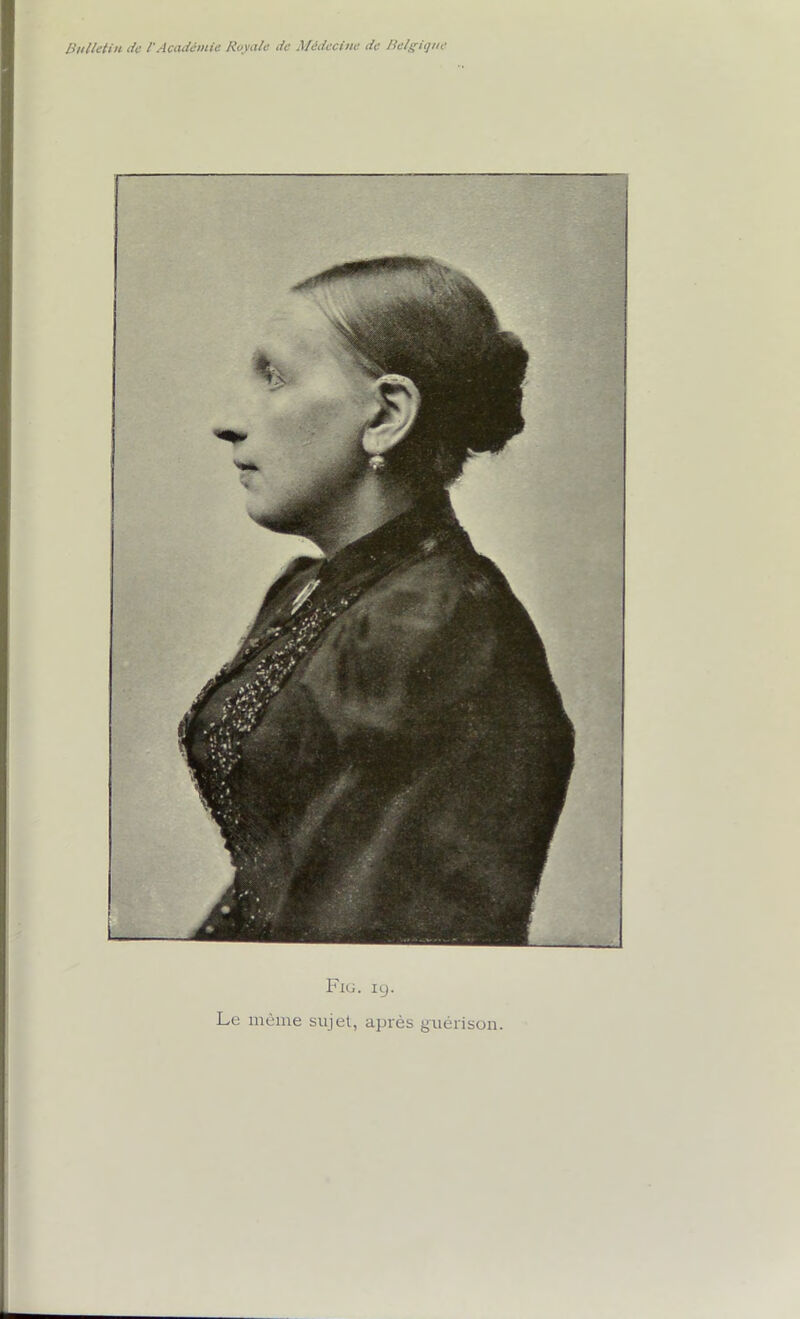 Fig. 19. Le même sujet, après guérison.