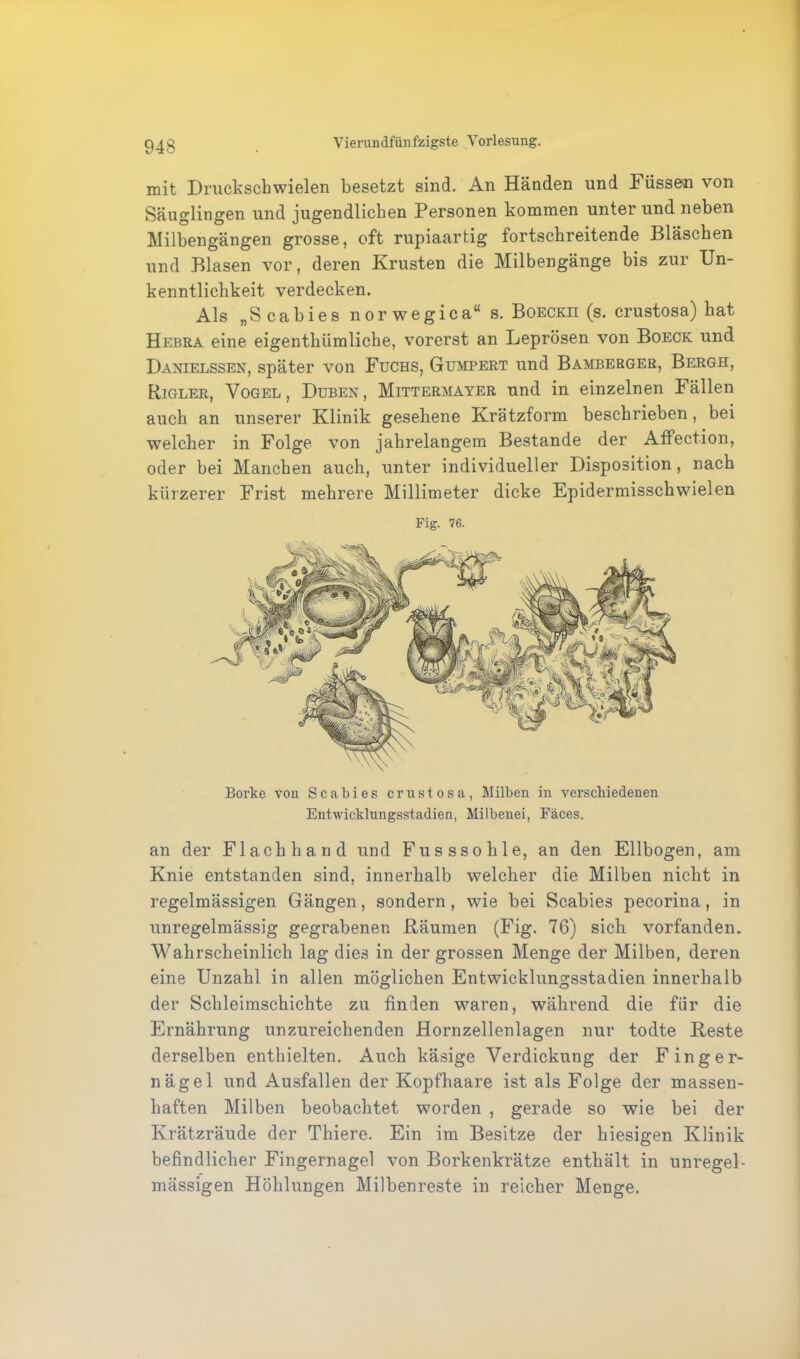 mit Druckschwielen besetzt sind. An Händen und Füssen von Säuglingen und jugendlichen Personen kommen unter und neben Milbengängen grosse, oft rupiaartig fortschreitende Bläschen und Blasen vor, deren Krusten die Milbengänge bis zur Un- kenntlichkeit verdecken. Als „Scabies norwegica“ s. Boeckii (s. crustosa) hat Hebra eine eigenthümliche, vorerst an Leprösen von Boeck und Danielssen, später von Fuchs, Gumpert und Bamberger, Bergh, Rigler, Vogel, Düben, Mittermayer und in einzelnen Fällen auch an unserer Klinik gesehene Krätzform beschrieben, bei welcher in Folge von jahrelangem Bestände der Affection, oder bei Manchen auch, unter individueller Disposition, nach kürzerer Frist mehrere Millimeter dicke Epidermisschwielen Fig. 76. V Borke von Scabies crustosa, Milben in verschiedenen Entwicklungsstadien, Milbenei, Fäces. an der Flach ha nd und Fusssohle, an den Ellbogen, am Knie entstanden sind, innerhalb welcher die Milben nicht in regelmässigen Gängen, sondern, wie bei Scabies pecorina, in unregelmässig gegrabenen Räumen (Fig. 76) sich vorfanden. Wahrscheinlich lag dies in der grossen Menge der Milben, deren eine Unzahl in allen möglichen Entwicklungsstadien innerhalb der Schleimschichte zu finden waren, während die für die Ernährung unzureichenden Hornzellenlagen nur todte Reste derselben enthielten. Auch käsige Verdickung der Finger- nägel und Ausfallen der Kopfhaare ist als Folge der massen- haften Milben beobachtet worden , gerade so wie bei der Krätzräude der Thiere. Ein im Besitze der hiesigen Klinik befindlicher Fingernagel von Borkenkrätze enthält in unregel- mässigen Höhlungen Milbenreste in reicher Menge.