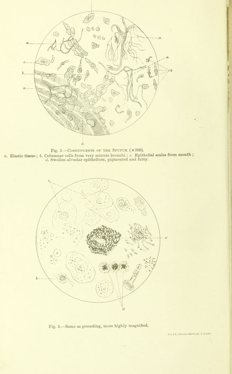 v? b Fig. 2.—Constituents of the Sputum ( x 300). a. Elastic tissue ; 6. Columnar cells from very minute bronchi; c. Epithelial scales from mouth ; U. Swollen alveolar epithelium, pigmented and fatty. {■ Fig. 3.—Same aa preceding, more highly magnified.