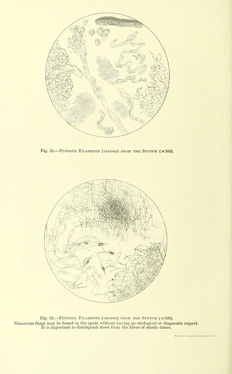 Jim: Fig. 32.—Fungous Filaments (various) from the Sputum (x 300). Fig. 33.—Fungous Filaments (various) from the Sputum (x 300). Numerous fungi may be found in the sputa without having an etiological or diagnostic import. It is important to distinguish these from the fibres of elastic tissue.