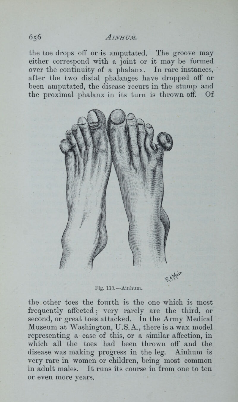 the toe drops off or is amputated. The groove may either correspond with a joint or it may be formed over the continuity of a phalanx. In rare instances, after the two distal phalanges have dropped off or been amputated, the disease recurs in the stump and the proximal phalanx in its turn is thrown off. Of the other toes the fourth is the one which is most frequently affected; very rarely are the third, or second, or great toes attacked. In the Army Medical Museum at Washington, U.S. A., there is a wax model representing a case of this, or a similar affection, in which all the toes had been thrown off and the disease was making progress in the leg. Ainhum is very rare in women or children, being most common in adult males. It runs its course in from one to ten or even more years. Fig. 113.—Ainhum,