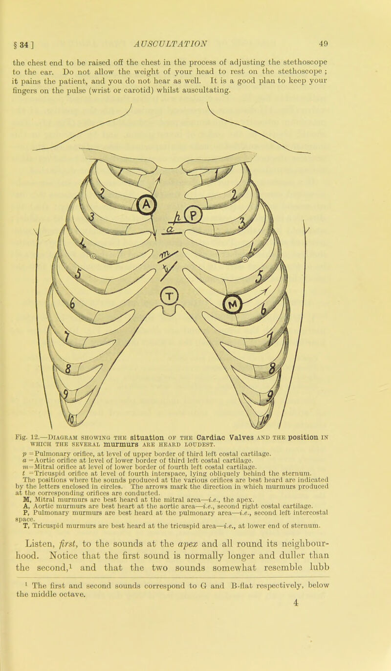 §34] AUSCULTATION 40 the chest end to be raised off the chest in the process of adjusting the stethoscope to the ear. Do not allow the weight of your head to rest on the stethoscope ; it pains the patient, and you do not hear as well. It is a good plan to keep your fingers on the pulse (wrist or carotid) whilst auscultating. Fig. 12.—Diagram showing the situation op the Cardiac Valves and the position in which the several murmurs are heard loudest. V = Pulmonary orifice, at level of upper border of third left costal cartilage. a =Aortic orifice at level of lower border of third left costal cartilage. m=Mitral orifice at level of lower border of fourth left costal cartilage. t ^Tricuspid orifice at level of fourth interspace, lying obliquely behind the sternum. The positions where the sounds produced at the various orifices are best heard are indicated by the letters enclosed in circles. The arrows mark the direction in which murmurs produced at the corresponding orifices are conducted. M, Mitral murmurs are best heard at the mitral area—i.e., the apex. A, Aortic murmurs are best heart at the aortic area—i.e., second right costal cartilage. P, Pulmonary murmurs are best heard at the pulmonary area—i.e., second left intercostal space. T, Tricuspid murmurs are best heard at the tricuspid area—i.e., at lower end of sternum. Listen, first, to tlie sounds at the apex and all round its neighbour- hood. Notice that the first sound is normally longer and duller than the second,1 and that the two sounds somewhat resemble lubb 1 The first and second sounds correspond to G and B-llat respectively, below the middle octave. 4