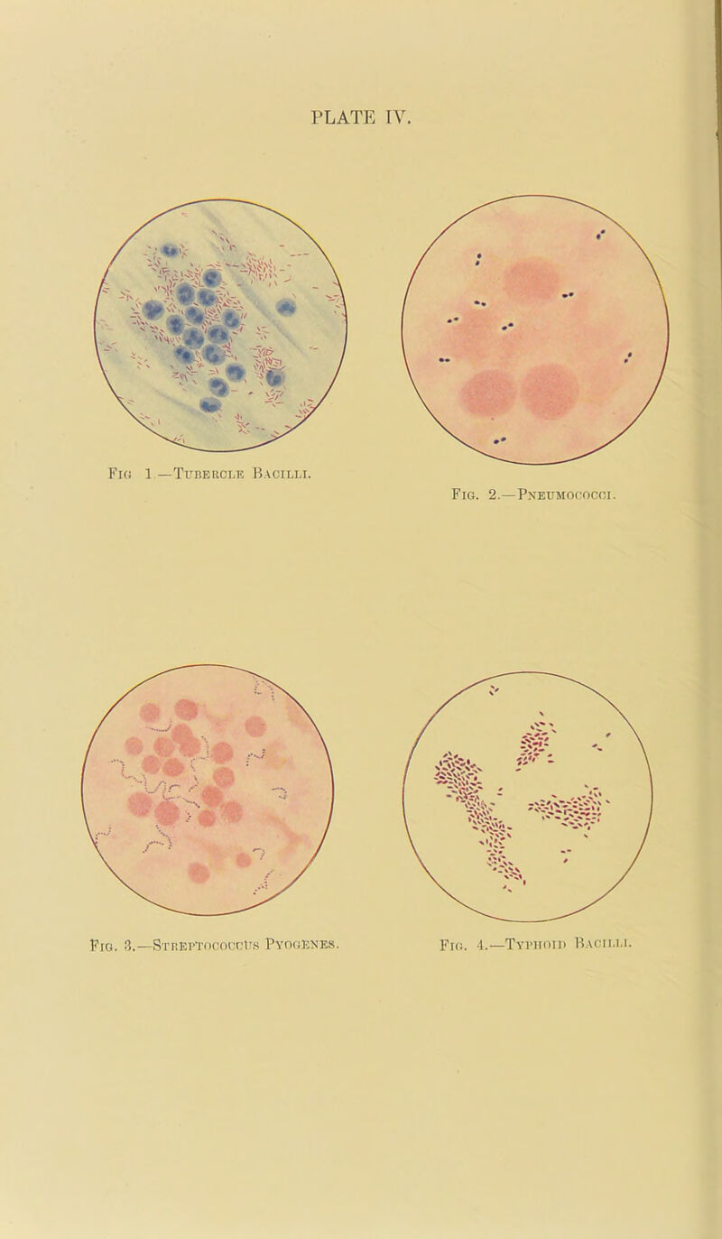 Fig 1 —Tubercle Bacilli. Fig. 2.—Pneumococci.