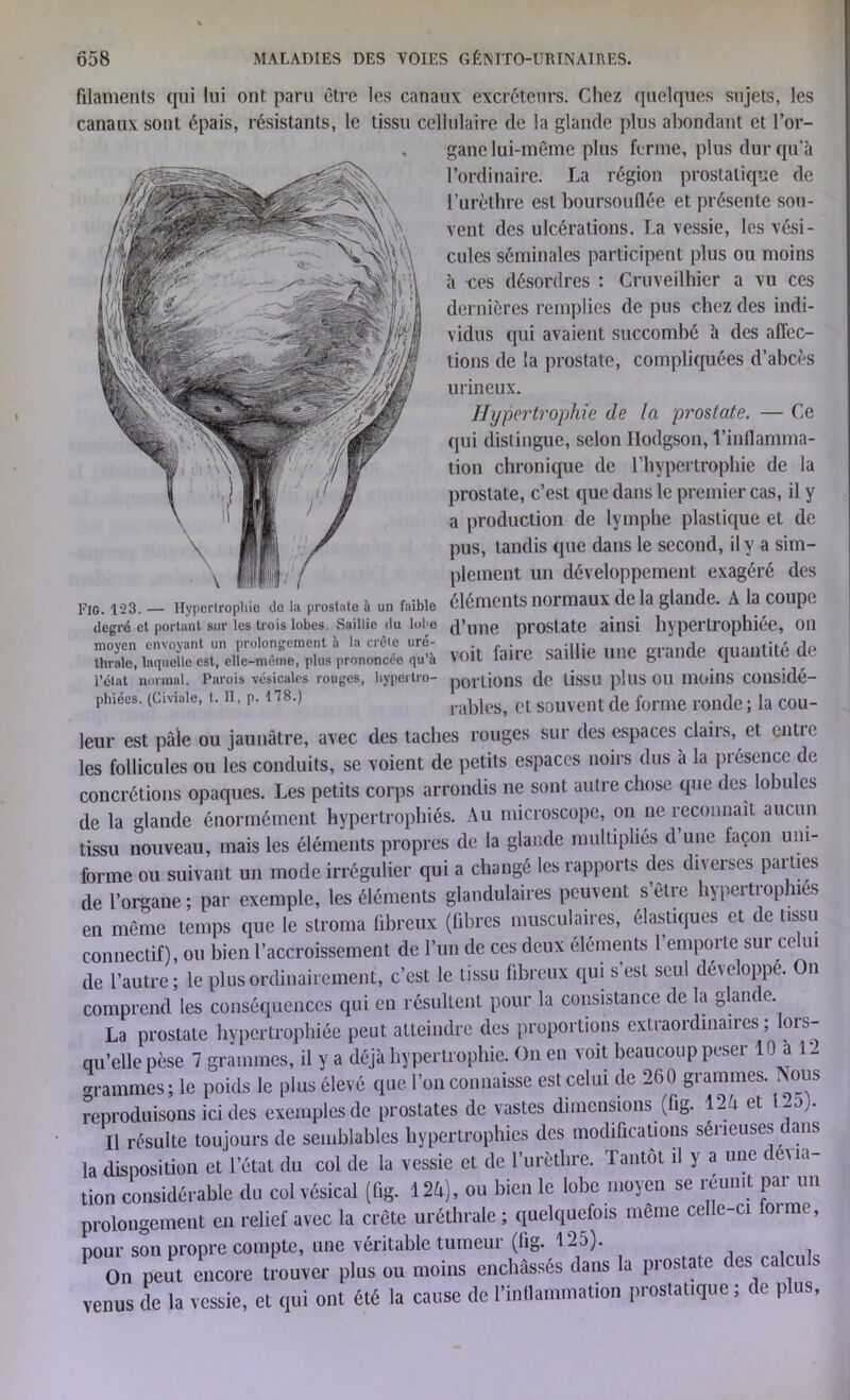 filaments qui lui ont paru être les canaux excréteurs. Chez quelques sujets, les canaux sont épais, résistants, le tissu cellulaire de la glande plus abondant et l’or- gane lui-même plus ferme, plus dur qu’à l’ordinaire. La région prostatique de l’urèthre est boursouflée et présente sou- vent des ulcérations. La vessie, les vési- cules séminales participent plus ou moins à ces désordres : Cruveilhier a vu ces dernières remplies de pus chez des indi- vidus qui avaient succombé à des affec- tions de la prostate, compliquées d’abcès urineux. Hypertrophie de la 'prostate. — Ce qui distingue, selon Ilodgson, l’inflamma- tion chronique de l’hvpertrophie de la prostate, c’est que dans le premier cas, il y a production de lymphe plastique et de pus, tandis que dans le second, il y a sim- plement un développement exagéré des Fig. 123. - Hyperirophi'e de il presse à un faible éléments normaux de la glande. A la coupe degré et portant sur les trois lobes. Saillie du lobe prostate ainsi livpertl’ophiée, 011 voit faite saillie une grande quantité de l’élat normal. Parois vésicales rouges, byp.ertro- portions de tissu plus OU moins COllSldé- phiées. (Civiuie, t. il, p. iT8.) râbles, et souvent de forme ronde; la cou- leur est pâle ou jaunâtre, avec des taches rouges sur des espaces clairs, et entre les follicules ou les conduits, se voient de petits espaces noirs dus à la présence de concrétions opaques. Les petits corps arrondis ne sont autre chose que des lobules de la glande énormément hypertrophiés. Au microscope, on ne reconnaît aucun tissu nouveau, mais les éléments propres de la glande multipliés d une façon uni- forme ou suivant un mode irrégulier qui a changé les rapports des diverses parties de l’organe; par exemple, les éléments glandulaires peuvent s’être hypertrophiés en même temps que le stroma fibreux (fibres musculaires, élastiques et de tissu connectif), ou bien l’accroissement de l’un de ces deux éléments 1 emporte sur ce ui de l’autre; le plus ordinairement, c’est le tissu fibreux qui s est seul dé\ eloppe. n comprend les conséquences qui en résultent pour la consistance de la glande. La prostate hypertrophiée peut atteindre des proportions extraordinaires ; lors- qu’elle pèse 7 grammes, il y a déjà hypertrophie. On en voit beaucoup peser 10 a 1 - grammes; le poids le plus élevé que l’on connaisse est celui de 260 grammes. ISous reproduisons ici des exemples de prostates de vastes dimensions (fig. 12^ et -n). Il résulte toujours de semblables hypertrophies des modifications sérieuses t ans la disposition et l’état du col de la vessie et de l’urèthre. Tantôt il y a une t eua tion considérable du col vésical (fig. 124), ou bien le lobe moyen se réunit par un prolongement en relief avec la crête uréthrale; quelquefois meme celle-ci foi me, pour son propre compte, une véritable tumeur (fig. 125). P On peut encore trouver plus ou moins enchâssés dans la prostate des calculs venus de la vessie, et qui ont été la cause de l'inflammation prostatique , de plus.