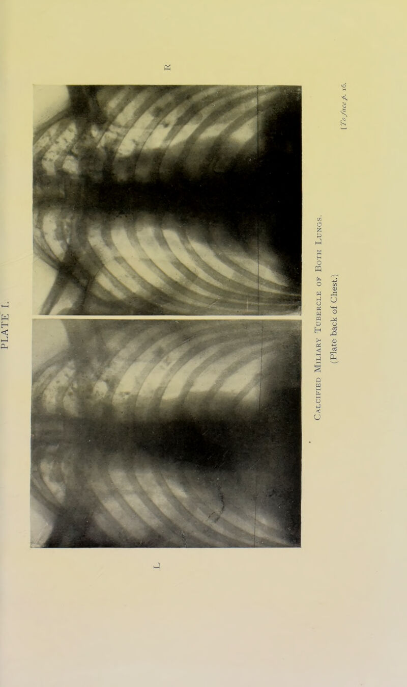 PLATE I. Calcified Miliary Tubercle of Both Lungs.