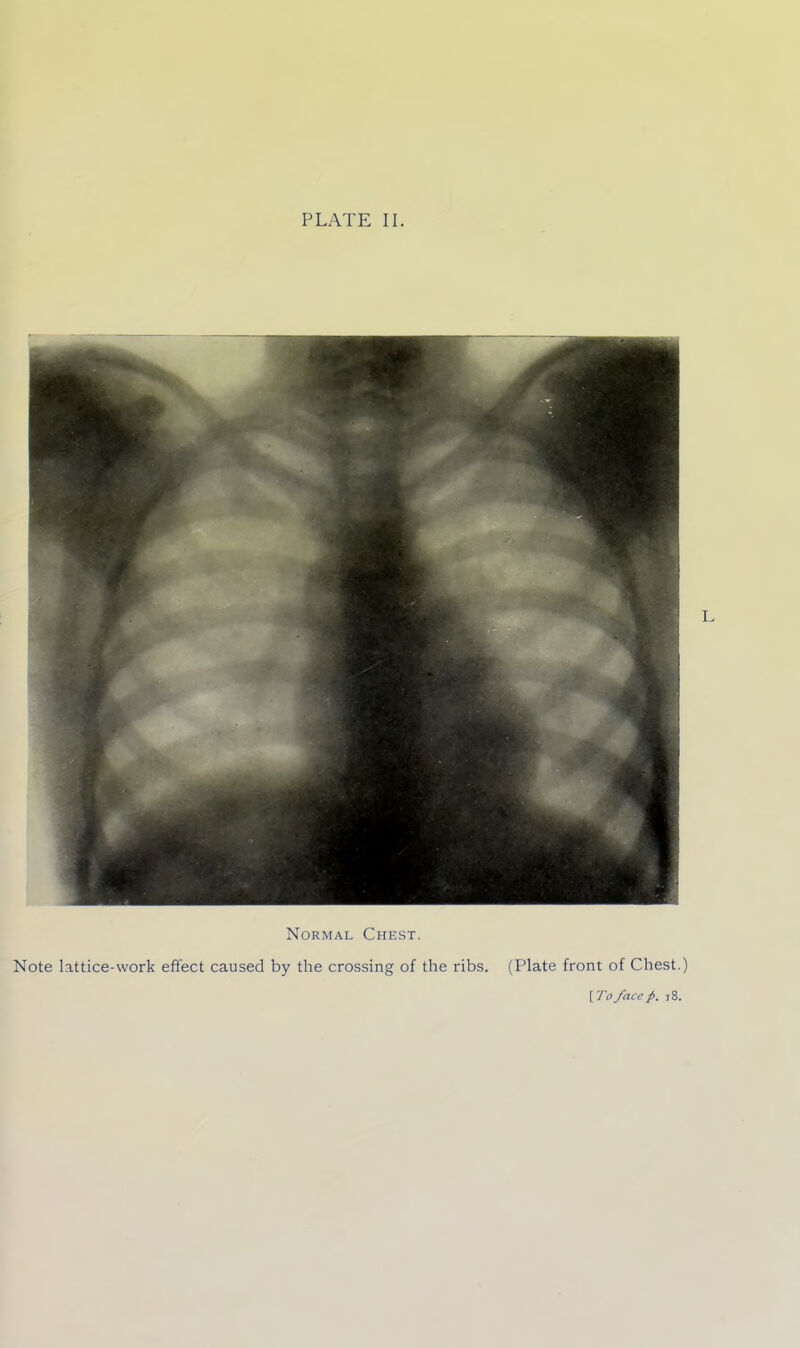 L Normal Chest. Note lattice-work effect caused by the crossing of the ribs. (Plate front of Chest.) [To face ft. 18.