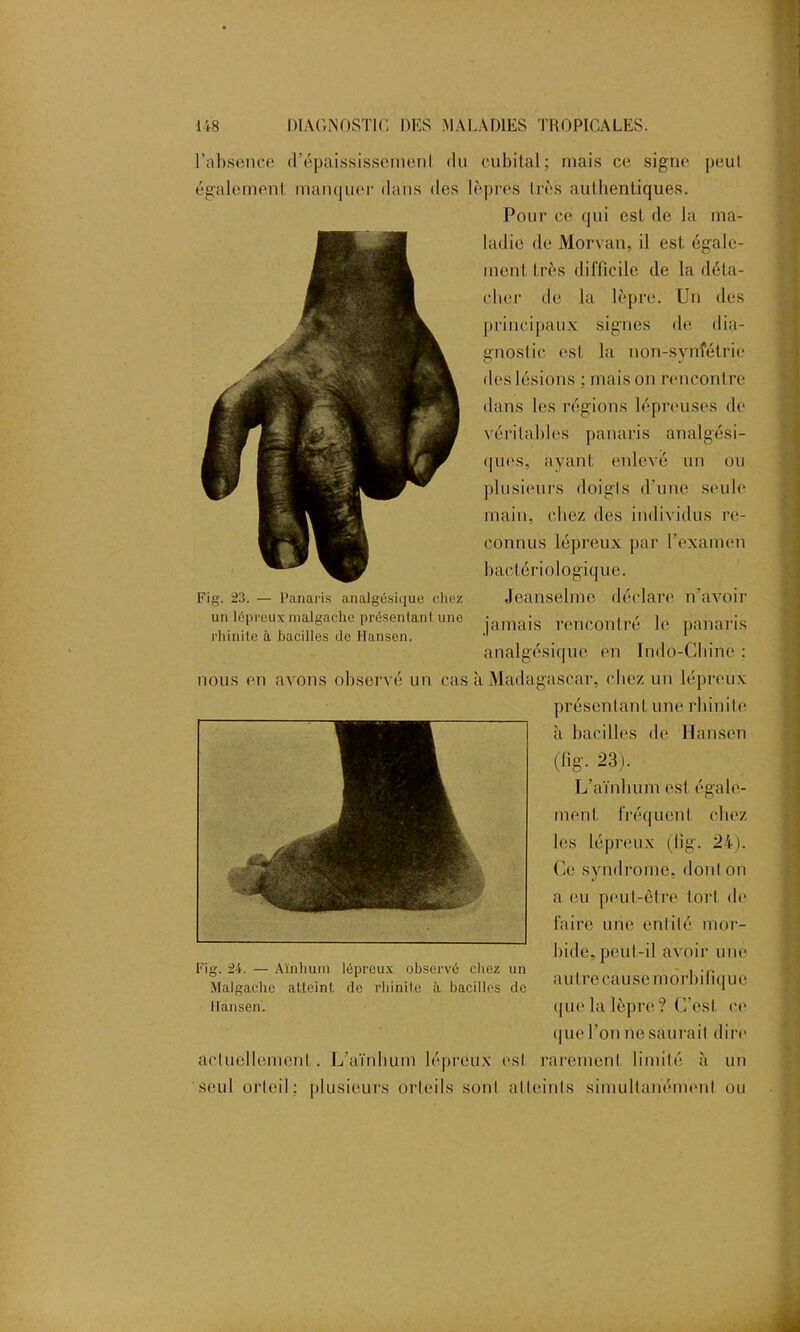 l’absence tl’épaississemenl du cubital; mais ce signe peul également manquer dans des lèpres très authentiques. Pour ce qui est de la ma- ladie de Morvan, il est égale- ment très difficile de la déta- cher de la lèpre. Un des principaux signes de dia- gnostic est la non-synfétrie des lésions ; maison rencontre dans les régions lépreuses de véritables panaris analgési- ques, ayant enlevé un ou plusieurs doigts d'une seule main, chez des individus re- connus lépreux par l’examen bactériologique. Jeanselme déclare n’avoir jamais rencontré le panaris analgésique en Indo-Chine : nous en avons observé un cas à Madagascar, chez un lépreux présentai! t une rhinite à bacilles de Hansen (fig. 23). L’aïnhum est égale- ment fréquent chez les lépreux (fig. 24). Ce syndrome, dont on a eu peut-être tort de faire une entité mor- bide, peul-il avoir une au t re ca use môrhifiqu e que la lèpre ? C’est ce Fig. 23. — Panaris analgésique chez un lépreux malgache présentant une rhinite à bacilles de Hansen. Fig. 24. — Aïnhum lépreux observé chez un Malgache atteint de rhinite à bacilles de Hansen. que l’on ne saurait dire actuellement. L’aïnhum lépreux est rarement limité à un seul orteil; plusieurs orteils sont atteints simultanément ou
