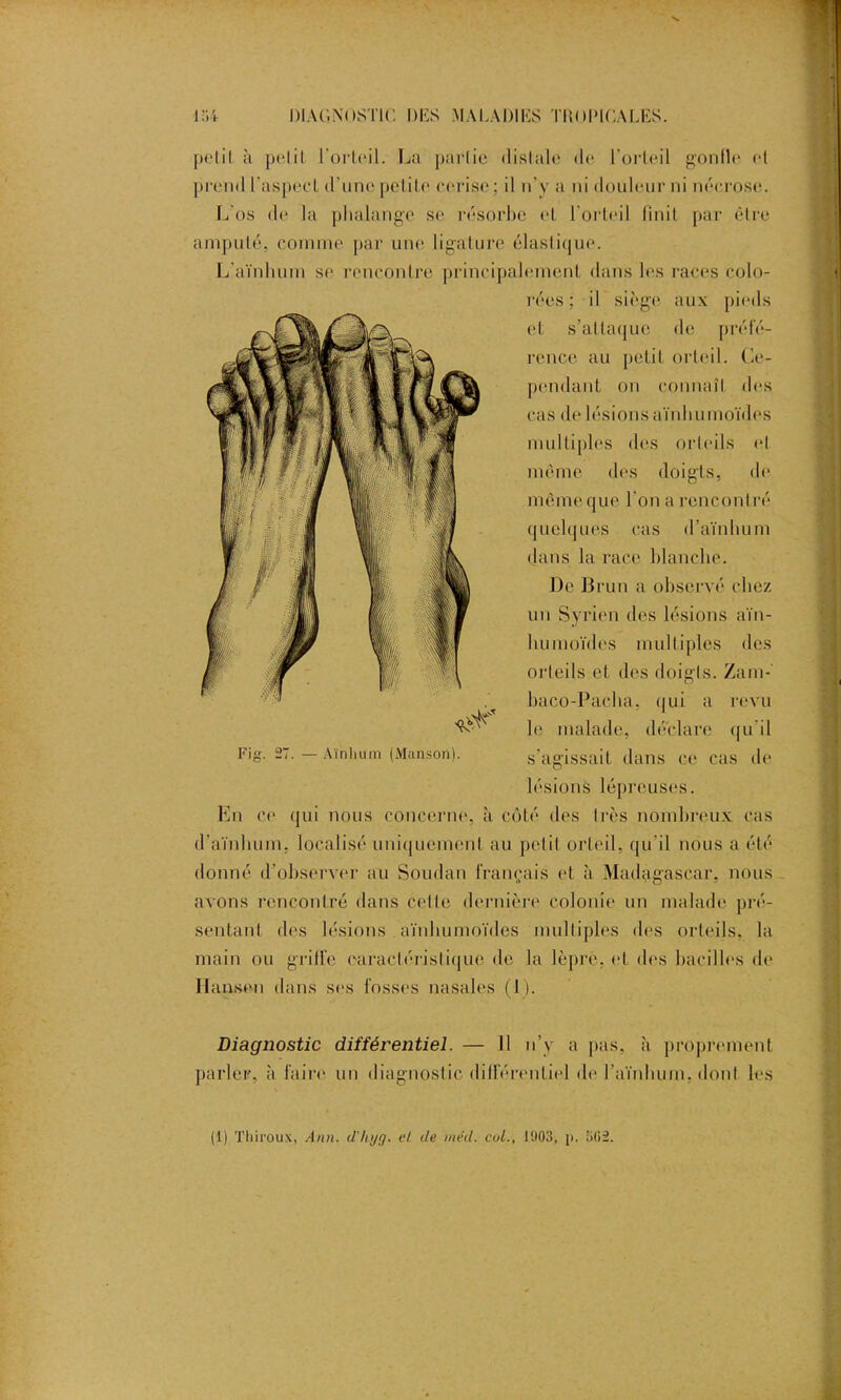 petit, à petit l'orteil. La partie distale de l’orteil gonfle et prend l'aspect d’une petite cerise; il n’y a ni douleur ni nécrose. L os de la phalange se résorbe et l’orteil finit par être amputé, comme par une ligature élastique. L’aïnhum se rencontre principalement dans les races colo- rées ; il siège aux pieds et s’attaque de préfé- rence au petit orteil. Ce- pendant on connaît des cas de lésionsaïnliumoïdes multiples des orteils et même des doigts, de même que l'on a rencontré quelques cas d’aïnhum dans la race blanche. De Brun a observé chez un Syrien des lésions aïn- bumoïdes multiples des orteils et des doigts. Zarn- baco-Pacha, qui a revu le malade, déclare qu’il Fig. 27. — Aïnlium (Manson). s’agissait dans ce cas de lésions lépreuses. En ce qui nous concerne, à côté des très nombreux cas d’aïnhum, localisé uniquement au petit orteil, qu'il nous a été donné d’observer au Soudan français et à Madagascar, nous avons rencontré dans celte dernière colonie un malade pré- sentant des lésions aïnliumoïdes multiples des orteils, la main ou griffe caractéristique de la lèpre, et des bacilles de Hansen dans ses fosses nasales (1 ). Diagnostic différentiel. — Il n’y a pas, à proprement parler, à faire un diagnostic différentiel de l’ambum, dont les