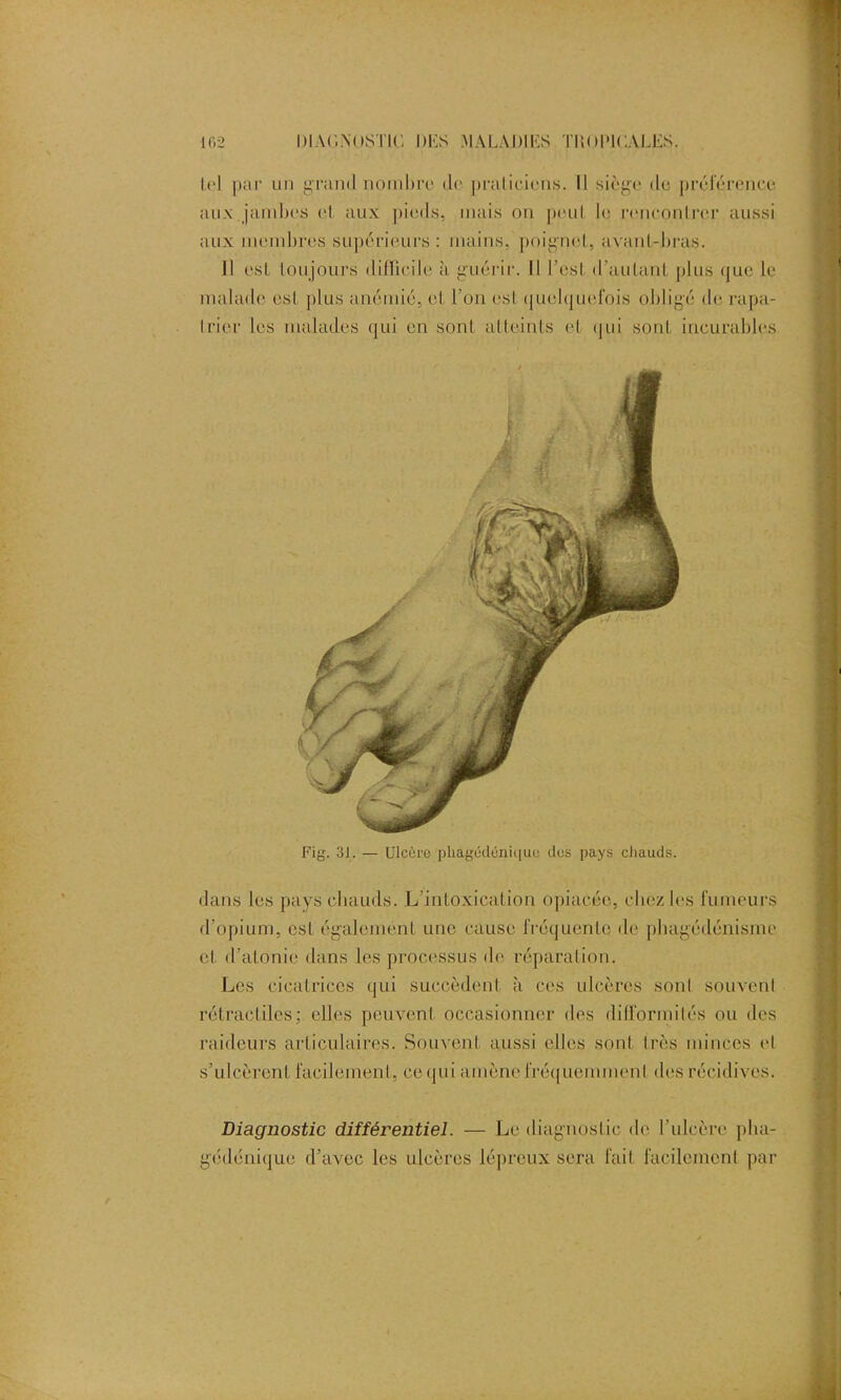 Ici par un grand nombre de praticiens. Il siège de préférence aux jambes cl aux pieds, mais on peut le rencontrer aussi aux membres supérieurs : mains, poignet, avant-bras. Jl est toujours difficile à guérir. Il l’est d’autant plus que le malade est plus anémié, et l’on esl quelquefois obligé de rapa- trier les malades qui en sont atteints cl qui sont incurables Fig. 31. — Ulcère pliagédéniquu des pays cliauds. dans les pays cliauds. L’intoxication opiacée, chez les l'umeur$ d’opium, esl également une cause fréquente de phagédénisme et d’atonie dans les processus de réparation. Les cicatrices qui succèdent à ces ulcères sont souvent rétractiles; elles peuvent occasionner des difformités ou des raideurs articulaires. Souvent aussi elles sont 1res minces et s’ulcèrent facilement, ce qui amène fréquemment des récidives. Diagnostic différentiel. — Le diagnostic de l'ulcère pha- gédénique d’avec les ulcères lépreux sera fait facilement par