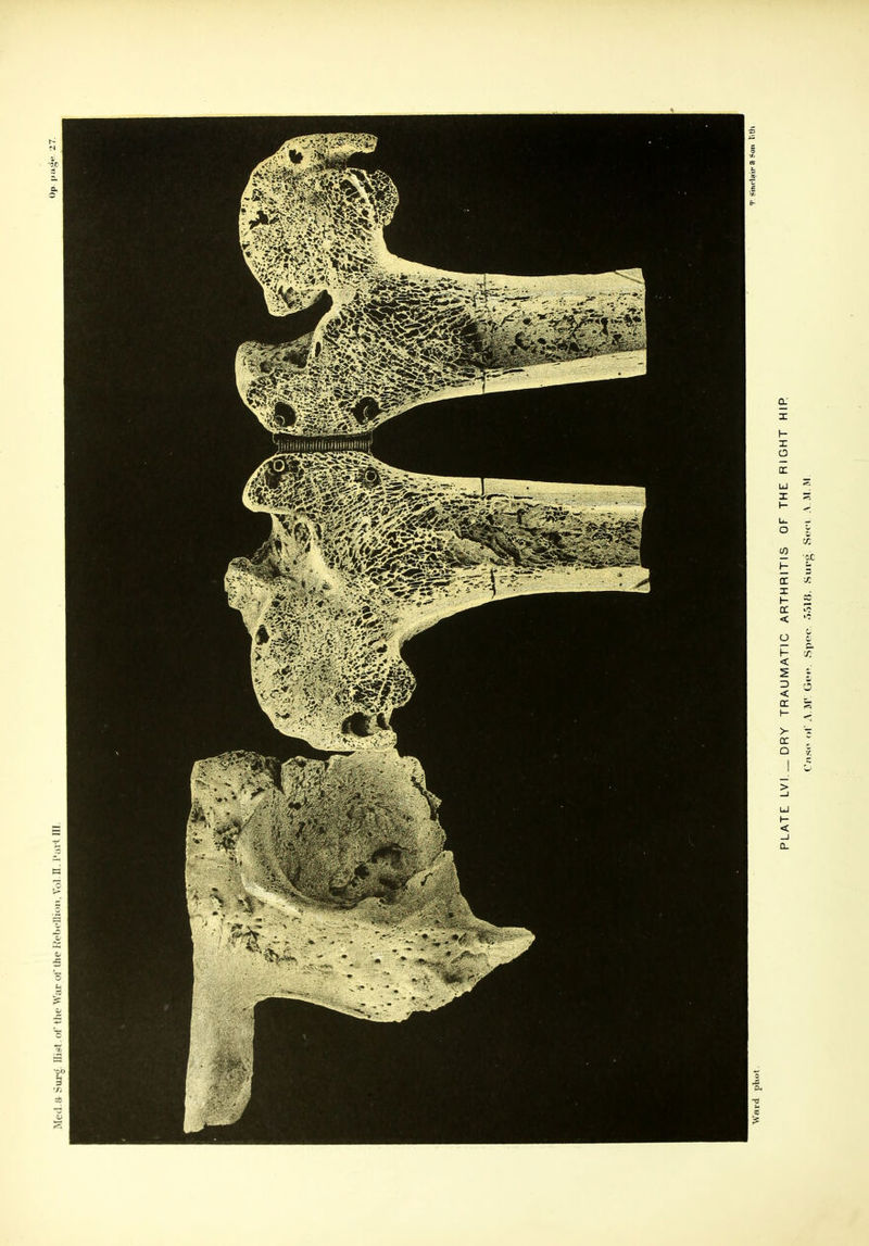 plate: lvi _dry traumatic arthritis of the right hip