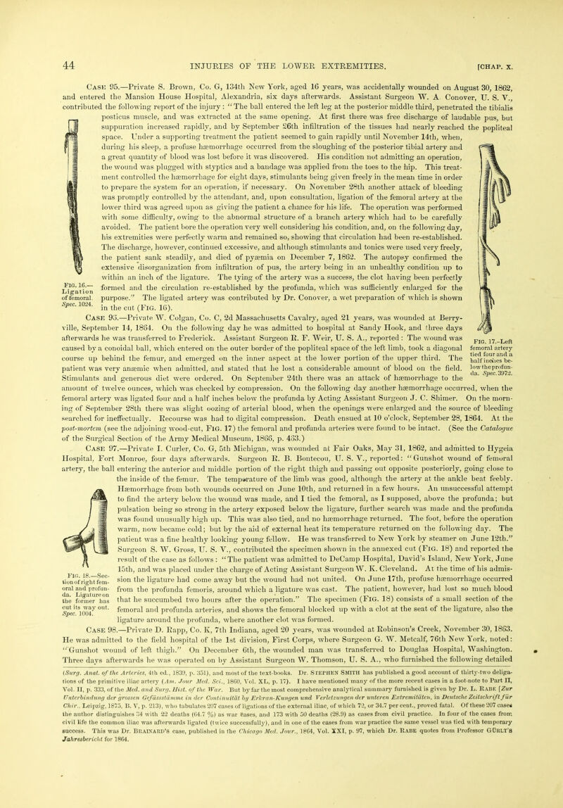 Fig. 16.— Ligation of femoral. Spec. 1024. Case 95.—Private S. Brown, Co. G, 134th New York, aged 16 years, was accidentally wounded on August 30, 1862, and entered the Mansion House Hospital, Alexandria, six days afterwards. Assistant Surgeon W. A Conover, U. S. V., contributed the following report of the injury : “ The ball entered the left leg at the posterior middle third, penetrated the tibialis posticus muscle, and was extracted at the same opening. At first there was free discharge of laudable pus, but suppuration increased rapidly, and by September 26th infiltration of the tissues had nearly reached the popliteal space. Under a supporting treatment the patient seemed to gain rapidly until November 14th, when, during his sleep, a profuse haemorrhage occurred from the sloughing of the posterior tibial artery and a great quantity of blood was lost before it was discovered. His condition not admitting an operation, the wound was plugged with styptics and a bandage was applied from the toes to the hip. This treat- ment controlled the haemorrhage for eight days, stimulants being given freely in the mean time in order to prepare the system for an operation, if necessary. On November 28th another attack of bleeding was promptly controlled by the attendant, and, upon consultation, ligation of the femoral artery at the lower third was agreed upon as giving the patient a chance for his life. The operation was performed with some difficulty, owing to the abnormal structure of a branch artery which had to be carefully avoided. The patient bore the operation very well considering his condition, and, on the following day, his extremities were perfectly warm and remained so, showing that circulation had been re-established. The discharge, however, continued excessive, and although stimulants and tonics were used very freely, the patient sank steadily, and died of pyaemia on December 7, 1862. The autopsy confirmed the extensive disorganization from infiltration of pus, the artery being in an unhealthy condition up to within an inch of the ligature. The tying of the artery was a success, the clot having been perfectly formed and the circulation re-established by the profunda, which was sufficiently enlarged for the purpose.” The ligated artery was contributed by Dr. Conover, a wet preparation of which is shown in the cut (Fig. 16). Case 96.-—Private W. Colgan, Co. C, 2d Massachusetts Cavalry, aged 21 years, was wounded at Berry- ville, September 14, 1884. On the following day he was admitted to hospital at Sandy Hook, and three days afterwards he was transferred to Frederick. Assistant Surgeon R. F. Weir, U. S. A., reported : The wound was caused by a conoidal ball, which entered on the outer border of the popliteal space of the left limb, took a diagonal course up behind the femur, and emerged on the inner aspect at the lower portion of the upper third. The patient was very anaemic when admitted, and stated that he lost a considerable amount of blood on the field. Stimulants and generous diet were ordered. On September 24th there was an attack of haemorrhage to the amount of twelve ounces, which was checked by compression. On the following day another haemorrhage occurred, when the femoral artery was ligated four and a half inches below the profunda by Acting Assistant Surgeon J. C. Shimer. On the morn- ing of September 28th there was slight oozing of arterial blood, when the openings were enlarged and the source of bleeding- searched for ineffectually. Recourse was had to digital compression. Death ensued at 10 o’clock, September 28, 1864. At the post-mortem, (see the adjoining wood-cut, Fig. 17) the femoral and profunda arteries were found to be intact. (See the Catalogue of the Surgical Section of the Army Medical Museum, 1866, p. 483.) Case 97.—Private I. Curler, Co. G, 5th Michigan, was wounded at Fair Oaks, May 31, 1862, and admitted to Hygeia Hospital, Fort Monroe, four days afterwards. Surgeon R. B. Bontecou, U. S. V., reported: Gunshot wound of femoral artery, the ball entering the anterior and middle portion of the right thigh and passing out opposite posteriorly, going close to the inside of the femur. The tempsrature of the limb was good, although the artery at the ankle beat feebly. Haemorrhage from both -wounds occurred on June 10th, and returned in a few hours. An unsuccessful attempt to find the artery below the wound was made, and I tied the femoral, as I supposed, above the profunda; but pulsation being so strong in the artery exposed below the ligature, further search was made and the profunda was found unusually high up. This was also tied, and no haemorrhage returned. The foot, before the operation warm, now became cold; but by the aid of external heat its temperature returned on the following day. The patient was a fine healthy looking young fellow. He was transferred to New York by steamer on June 12th.” Surgeon S. W. Gross, U. S. V., contributed the specimen shown in the annexed cut (Fig. 18) and reported the result of the case as follows : “The patient was admitted to DeCamp Hospital, David’s Island, New York, June 15tli, and was placed under the charge of Acting Assistant Surgeon W. K. Cleveland. At the time of his admis- sion the ligature had come away but the wound had not united. On June 17th, profuse haemorrhage occurred from the profunda femoris, around which a ligature was cast. The patient, however, had lost so much blood that he succumbed two hours after the operation.” The specimen (Fig. 18) consists of a small section of the femoral and profunda arteries, and shows the femoral blocked up with a clot at the seat of the ligature, also the ligature around the profunda, where another clot was formed. Case 98.—Private D. Rapp, Co. K, 7th Indiana, aged 20 years, was wounded at Robinson’s Creek, November 30,1883. He was admitted to the field hospital of the 1st division, First Corps, where Surgeon G. W. Metcalf, 76th New York, noted; “ Gunshot wound of left thigh.” On December 6th, the wounded man was transferred to Douglas Hospital, Washington. Three days afterwards he was operated on by Assistant Surgeon W. Thomson, U. S. A., who furnished the following detailed FIG. 17.-Left femoral artery- tied four and a half inches be- low the profun- da. Spec. 3972. FIG. 18.—Sec- tion of right fem- oral and profun- da. Ligature on the former has cut its way out. Spec. 1004. (Surg. Anat. of the Arteries, 4th ed., 1839, p. 351), and most of the text-books. Dr. STEPHEN Smith has published a good account of thirty-two deliga- tions of the primitive iliac artery (Am. Jour Med. Sci., 1860, Vol. XL, p. 17). I have mentioned many of the more recent cases in a foot-note to Part II, Vol. II, p. 333, of the Med. and Surg. Uist. of the War. But by far the most comprehensive analytical summary furnished is given by Dr. L. Rape [Zur TTnterbindung der grossen Gefdssstumme in dcr Continuitat by Erlcran-Kungen und Verletzungcn der unteren Extremitdten, in Deutsche Zeitschnft fur Cliir.. Leipzig, 1875, B. V, p. 213), who tabulates 207 cases of ligations of the external iliac, of which 72, or 34.7 per cent., proved fatal. Of these 207 cases the author distinguishes 34 with 22 deaths (64.7 %) as war eases, and 173 with 50 deaths (28.9) as cases from civil practice. In four of the cases from civil life the common iliac was afterwards ligated (twice successfully), and in one of the cases from war practice the same vessel was tied with temporary success. This was Dr. Braixard’S case, published in the Chicago Med. Jour., 1864, Vol. XXI, p. 97, which Dr. Rabe quotes from Professor GDrlt’s Jahresbericht for 1864.