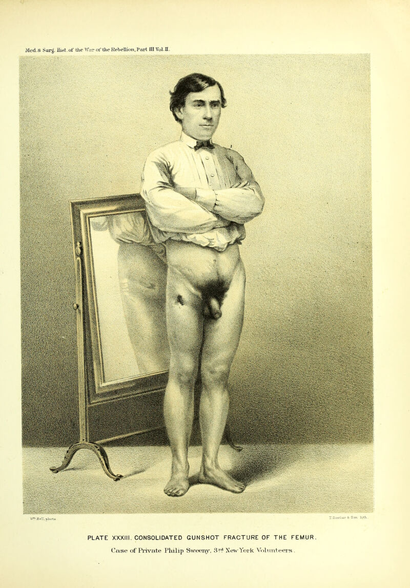 i\led.& Surg. Hist, of the War of the Rebellion, Part ill Vol.H T. Sinclair & S on litTv Vyr?J3ell.-photo PLATE XXXIII. CONSOLIDATED GUNSHOT FRACTURE OF THE FEMUR Case of Private Philip Sweeny, 3r'1 New York Volunteers .