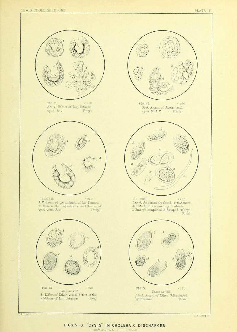 FIG. IX. ‘ 250 Same as VTTT 1. Effer± of Ether. 2, to 5, Effect of the addition of Liq_. Potassae (Ova) FIG. X. >‘250 Same sls YIU. l.to 6. Action of Ether. 3.Ruptured by pressure (Ova) FIG V- X 250 2.to A Effect of Liq. Pota^sse upon N°.Z. (Fatty) FIG.Vn. x250 lr2. Reo^uired the addition of Liq Potassse to dissolve the Capsules before Ether acted upon them ,3.-4. (Fath^) FIG, VIII. x250 l.to 4, As commonly found. 5r6.Amore dehnite form assumed by Contents 7, Embryo completed 5. Escaped embryo (Ova) FIG. VI. x250 3.-5. Action of Acetic acid upon 1.-2. (Fatty) FIGS: V.-X. CYSTS” IN CHOLERAIC DISCHARGES. 1000^ of an inch 250
