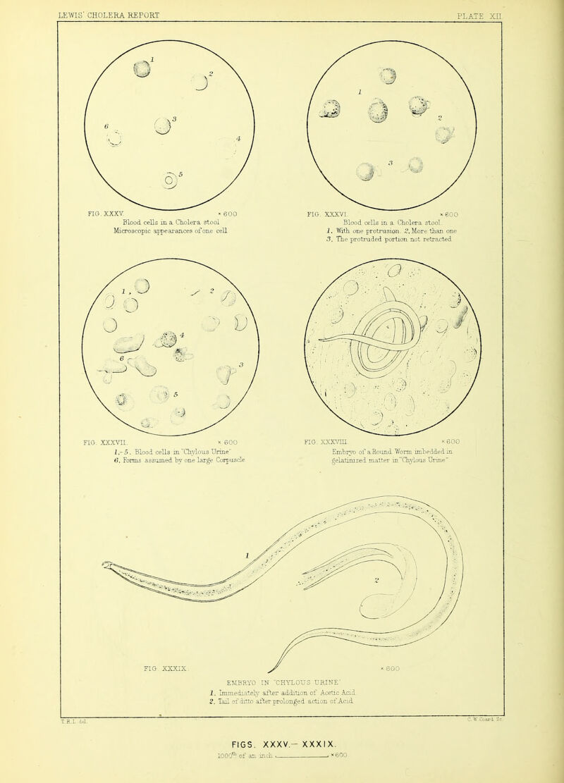 FIG.XJCXV; « 600 Blood cells in a CEolera stool Microscopic appearances of one cell FIG. XXX.VL. x600 Blood cells in a Cholera stool, 1. With one protrusion. More than one 3. The protruded portion not retracted FIG, XXXVII. X 600 Ir 5. Blood cells m Chylous Urine 6. Forms assumed by one large Corpuscle FIG. xxxvm. x600 Embryo of aRound Worm imbedded in gelatinized matter in Chylous Thine EMBRYO IN CHYLOUS URINE 1. Immediately after addition of Acetic Acid 2. Tail of ditto after prolonged action of Acid FIGS. XXXV.- XXXIX. lOOC^ of ^in inch . '‘600