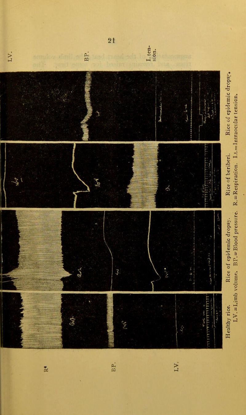 > h4 21 cu CQ I c • <V C *■; o hH W Healthy rice. Rice of epidemic dropsy. Rice of beriberi. Rice of epidemic dropsy, LV. = Limb volume. BP.-Blood pressure. R. = Respiration. I.t.=Intraocular tension.