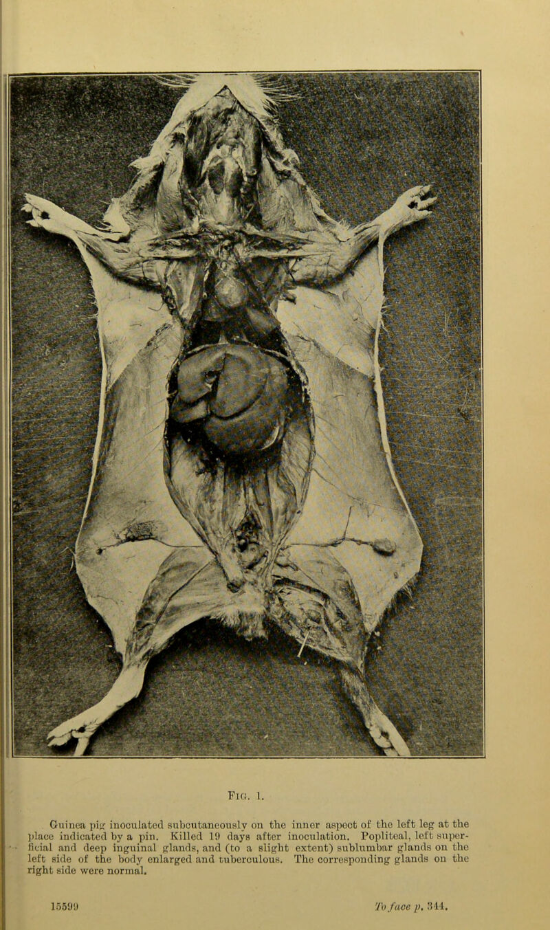 Guinea pi«r inoculated subcutaneously on the inner aspect of the left leg at the place indicated by a pin. Killed 19 days after inoculation. Popliteal, left super- ficial and deep inguinal glands, and (to a slight extent) sublumbar glands on the left side of the body enlarged and tuberculous. The corresponding glands on the right side were normal. 15599 To face />. '141.