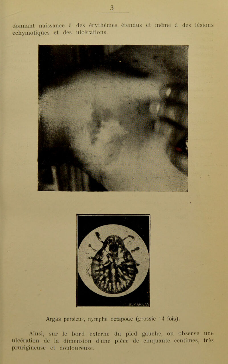 donnant naissance a ties erylhemes elendus el ineme a des lesions echymotiqiies et des ulcerations. / Argas persicur, nymphe octapode (grossic 14 fois). Ainsi, sur le bord externe du pied gauche, on observe ulceration de la dimension d une piece de cinquanle centimes, prurigineuse et douloureuse. line Ires