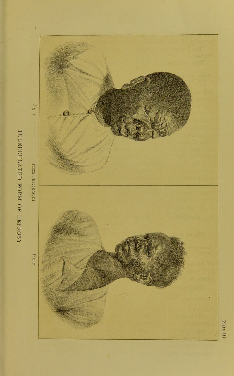 TUBERCULATED FORM OF LEPROSY t