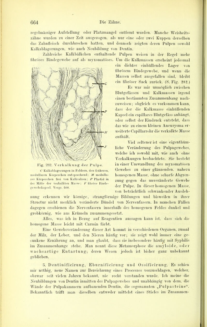 regelmässiger Aufstellung oder Platzmangel entfernt wurden. Manche Weisheits- zähne wurden zu einer Zeit ausgezogen, als nur eine oder zwei Kuppen derselben das Zahnfleisch durchbrochen hatten, und dennoch zeigten deren Pulpen sowohl Kalkablagerungen, wie auch Neubildung von Dentin. Zahlreiche Kalkbälkchen enthaltende Pulpen weisen in der Regel mehr fibröses Bindegewebe auf als myxomatöses. Um die Kalkmassen erscheint jedesmal ein dichtes einhüllendes Lager von fibrösem Bindegewebe, und wenn die Massen selbst ausgefallen sind, bleibt ein fibröser Sack zurück. (S. Fig. 282.) Es war mir unmöglich zwischen Blutgefässen und Kalkmassen irgend einen bestimmten Zusammenhang nach- zuweisen ; obgleich es Vorkommen kann, dass der die Kalkmasse einhüllenden Kapsel ein capillares Blutgefäss anhängt, oder selbst der Eindruck entsteht, dass das wie zu einem kleinen Aneurysma er- weiterte Capillarrohr die verkalkte Masse enthält. Viel seltener ist eine eigenthüm- liche Veränderung des Pulpagewebes, welche ich sowohl mit, wie auch ohne Verkalkungen beobachtete. Sie besteht in einer Umwandlung des myxomatösen Gewebes zu einer glänzenden, nahezu homogenen Masse, ohne scharfe Abgren- zung gegen das unveränderte Gewebe der Pulpe. In dieser homogenen Masse, von beträchtlich schwankender Ausdeh- nung erkennen wir körnige, strangförmige Bildungen und bisweilen in ihrer Structur nicht merklich veränderte Bündel von Nervenfasern. In manchen Fällen dagegen erschienen die Nervenfasern innerhalb des homogenen Feldes dunkel und grobkörnig, wie aus Krümeln zusammengesetzt. Alles, was ich in Bezug auf Reagentien aussagen kann ist, dass sich die homogene Masse leicht mit Carmin färbt. Eine Gewebsveränderung dieser Art kommt in verschiedenen Organen, zumal der Milz, der Leber, und den Nieren häufig vor; sie zeigt wohl immer eine ge- sunkene Ernährung an, und man glaubt, dass sie insbesondere häufig mit Syphilis im Zusammenhänge stehe. Man nennt diese Metamorphose die amyloide, oder wachsartige Entartung; deren Wesen jedoch ist bisher ganz unbekannt geblieben. 282. Verkalkung der C Kalkablagerungen in Feldern, den früheren, medullären Körperchen entsprechend: M medullä- res Körperchen frei von Kalksalzen; P Plastid in der Mitte der verkalkten Masse; F fibröse Binde- gewebskapsel. Vergr. 600. 5. Dentinificirung, Eburnificirung und Ossificirung. Es schien mir nöthig, neue Namen zur Bezeichnung eines Processes vorzuschlagen, welcher, obzwar seit vielen Jahren bekannt, nie recht verstanden wurde. Ich meine die Neubildungen von Dentin inmitten des Pulpagewebes und unabhängig von dem, die Wände der Pulpakammern aufbauenden Dentin, die sogenannten ,.Pulpasteine“. Bekanntlich trifft man dieselben entweder mittelst eines Stieles im Zusammen-