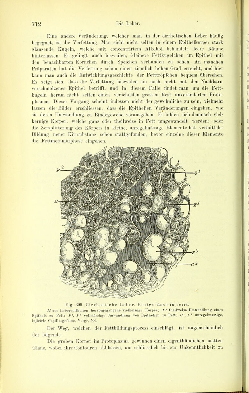 Eine andere Veränderung, welcher man in der cirrhotischen Leber häufig begegnet, ist die Verfettung. Man sieht nicht selten in einem Epithelkörper stark glänzende Kugeln, welche mit concentrirtem Alkohol behandelt, leere Räume hinterlassen. Es gelingt auch bisweilen, kleinere Fettkügelchen im Epithel mit den benachbarten Körnchen durch Speichen verbunden zu sehen. An manchen Präparaten hat die Verfettung schon einen ziemlich hohen Grad erreicht, und hier kann man auch die Entwicklungsgeschichte der Fetttröpfchen bequem übersehen. Es zeigt sich, dass die Verfettung bisweilen ein noch nicht mit den Nachbarn verschmolzenes Epithel betrifft, und in diesem Falle findet man um die Fett- kugeln herum nicht selten einen verschieden grossen Rest unveränderten Proto- plasmas. Dieser Vorgang scheint indessen nicht der gewöhnliche zu sein; vielmehr lassen die Bilder erschliessen, dass die Epitlrelien Veränderungen eingelien, wie sie deren Umwandlung zu Bindegewebe vorausgeben. Es bilden sich demnach viel- kernige Körper, welche ganz oder theilweise in Fett umgewandelt werden; oder die Zersplitterung des Körpers in kleine, unregelmässige Elemente hat vermittelst Bildung neuer Kittsubstanz schon stattgefunden, bevor einzelne dieser Elemente die Fettmetamorphose eingelien. Fig. 309. Cirrliotische Leber. Blutgefässe injicirt. M aus Leberepithelien hervorgegangene vielkernige Körper; F2 theilweise Umwandlung eines Epithels zu Fett; F’, F3 vollständige Umwandlung von Epithelien zu Fett; G’\ C'4 unregelmässige, injicirte G'apillargefässe. Vergr. 500. Der Weg, welchen der Fettbildungsprocess einschlägt, ist augenscheinlich der folgende: Die groben Körner im Protoplasma gewinnen einen eigenthümlichen, matten Glanz, wobei ihre Contouren abblassen, um schliesslich bis zur Unkenntlichkeit zu
