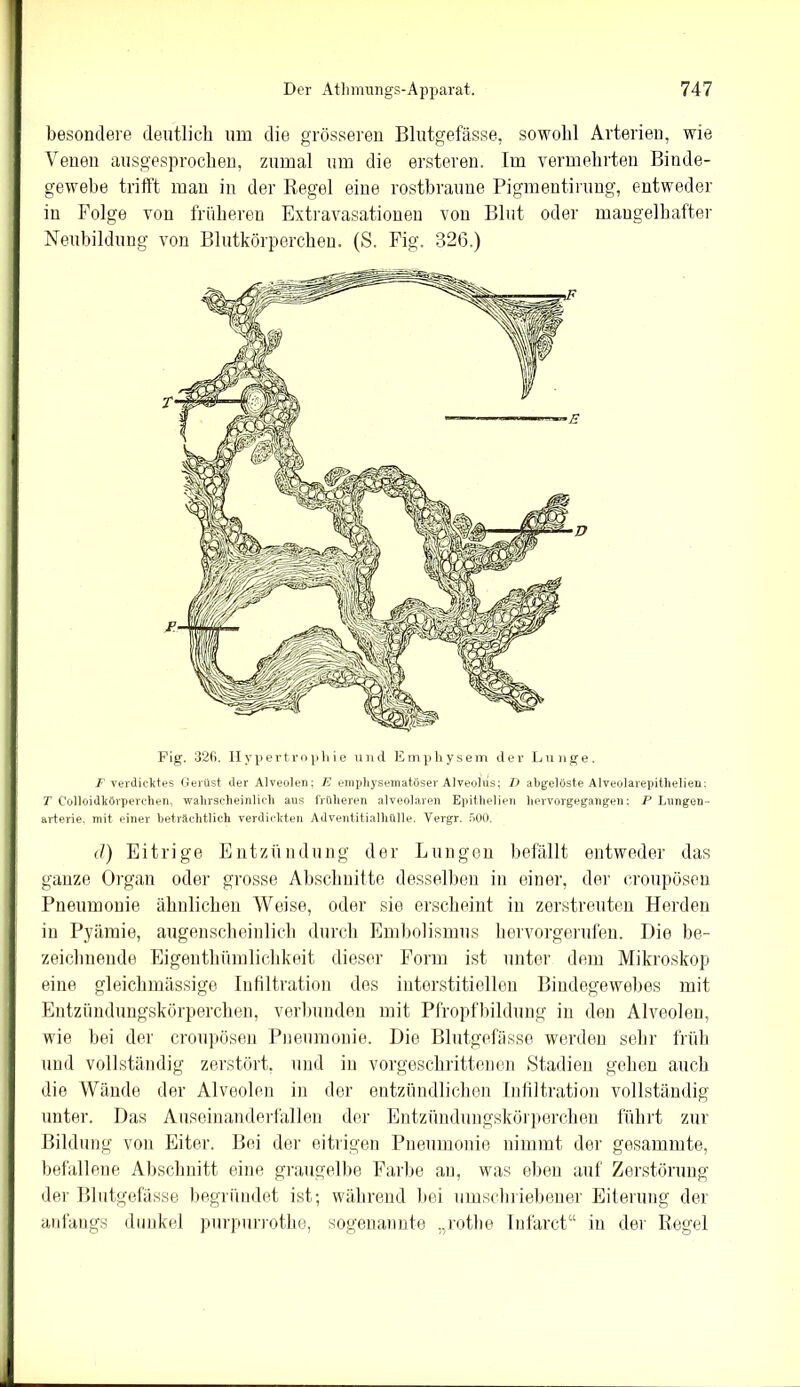 besondere deutlich um die grösseren Blutgefässe, sowohl Arterien, wie Venen ausgesprochen, zumal um die ersteren. Im vermehrten Binde- gewebe trifft mau in der Regel eine rostbraune Pigmeutirung, entweder in Folge von früheren Extravasationen von Blut oder mangelhafter Neubildung von Blutkörperchen. (S. Fig. 32(3.) Fig. 326. Hypertrophie und Emphysem der Lunge. F verdicktes Gerüst der Alveolen; E emphysematöser Alveolüs; D abgelöste Alveolarepithelien: T Colloidkörperchen, wahrscheinlich aus früheren alveolaren Epithelien hervorgegangen: P Lungen- arterie, mit einer beträchtlich verdickten Adventitialhülle. Yergr. 500. d) Eitrige Entzündung der Lungen befällt entweder das ganze Organ oder grosse Abschnitte desselben in einer, der croupösen Pneumonie ähnlichen Weise, oder sie erscheint in zerstreuten Herden in Pyämie, augenscheinlich durch Embolismus hervorgerufen. Die be- zeichnende Eigenthftmlichkeit dieser Form ist unter dem Mikroskop eine gleichmässige Infiltration des interstitiellen Bindegewebes mit Entzündungskörperchen, verbunden mit Pfropfbildung in den Alveolen, wie bei der croupösen Pneumonie. Die Blutgefässe werden sehr früh und vollständig zerstört, und in vorgeschrittenen Stadien gehen auch die Wände der Alveolen in der entzündlichen Infiltration vollständig unter. Das Auseinanderfällen der Entzündungskörperchen führt zur Bildung von Eiter. Bei der eitrigen Pneumonie nimmt der gesammte, befallene Abschnitt eine graugelbe Farbe an, was eben auf Zerstörung der Blutgefässe begründet ist; während bei umschriebener Eiterung der anfangs dunkel purpurrothe, sogenannte „rothe Infarct“ in der Regel