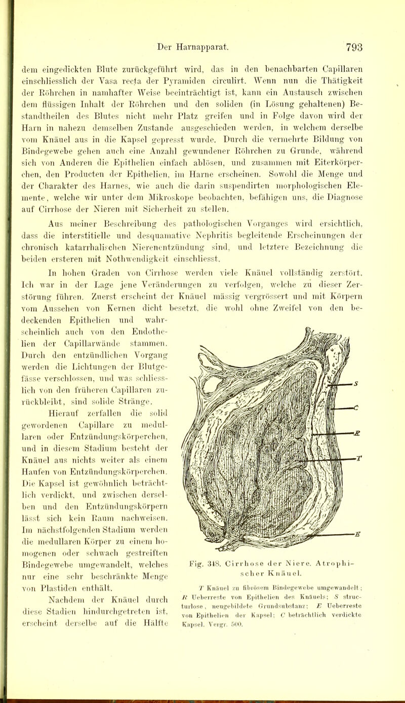 dem eingedickten Blute zurückgeführt wird, das in den benachbarten Capillaren einschliesslich der Vasa recta der Pyramiden circulirt. Wenn nun die Thätigkeit der Röhrchen in namhafter Weise beeinträchtigt ist, kann ein Austausch zwischen dem flüssigen Inhalt der Röhrchen und den soliden (in Lösung gehaltenen) Be- standtheilen des Blutes nicht mehr Platz greifen und in Folge davon wird der Harn in nahezu demselben Zustande ausgeschieden werden, in welchem derselbe vom Knäuel aus in die Kapsel gepresst wurde. Durch die vermehrte Bildung von Bindegewebe gehen auch eine Anzahl gewundener Röhrchen zu Grunde, während sich von Anderen die Epithelien einfach ablösen, und zusammen mit Eiterkörper- chen, den Produkten der Epithelien, im Harne erscheinen. Sowohl die Menge und der Charakter des Harnes, wie auch die darin suspendirten morphologischen Ele- mente, welche wir unter dem Mikroskope beobachten, befähigen uns, die Diagnose auf Cirrhose der Nieren mit Sicherheit zu stellen. Aus meiner Beschreibung des pathologischen Vorganges wird ersichtlich, dass die interstitielle und desquamative Nephritis begleitende Erscheinungen der chronisch katarrhalischen Nierenentzündung sind, und letztere Bezeichnung die beiden ersteren mit Nothwendigkeit einschliesst. In hohen Graden von Cirrhose werden viele Knäuel vollständig zerstört. Ich war in der Lage jene Veränderungen zu verfolgen, welche zu dieser Zer- störung führen. Zuerst erscheint der Knäuel mässig vergrössert und mit Körpern vom Aussehen von Kernen dicht besetzt, die wohl ohne Zweifel von den be- deckenden Epithelien und wahr- scheinlich auch von den Endothe- lien der Capillarwände stammen. Durch den entzündlichen Voi-gang werden die Lichtungen der Blutge- fässe verschlossen, und was schliess- lich von den früheren Capillaren zu- rückbleibt, sind solide Stränge. Hierauf zerfallen die solid gewordenen Capillare zu medul- lären oder Entzündungskörperchen, und in diesem Stadium besteht der Knäuel aus nichts weiter als einem Haufen von Entzündungskörperchen. Die Kapsel ist gewöhnlich beträcht- lich verdickt, und zwischen dersel- ben und den Entzündungskörpern lässt sich kein Raum nach weisen. Im nächstfolgenden Stadium werden die medullären Körper zu einem ho- mogenen oder schwach gestreiften Bindegewebe umgewandelt, welches nur eine sehr beschränkte Menge von Plastiden enthält. Nachdem der Knäuel durch diese Stadien hindurchgetreten ist, erscheint derselbe auf die Hälfte Fig. 348. Cirrhose der Niere. Atrophi- scher Knäuel. T Knäuel zu fibrösem Bindegewebe umgewandelt; H Ueherreste von Epithelien des Knäuels; S struc- turlose, neugebildete Grundsubstanz; E Ueberreste von Epithelien der Kapsel; C beträchtlich verdickte Kapsel. Yergr. 500. i